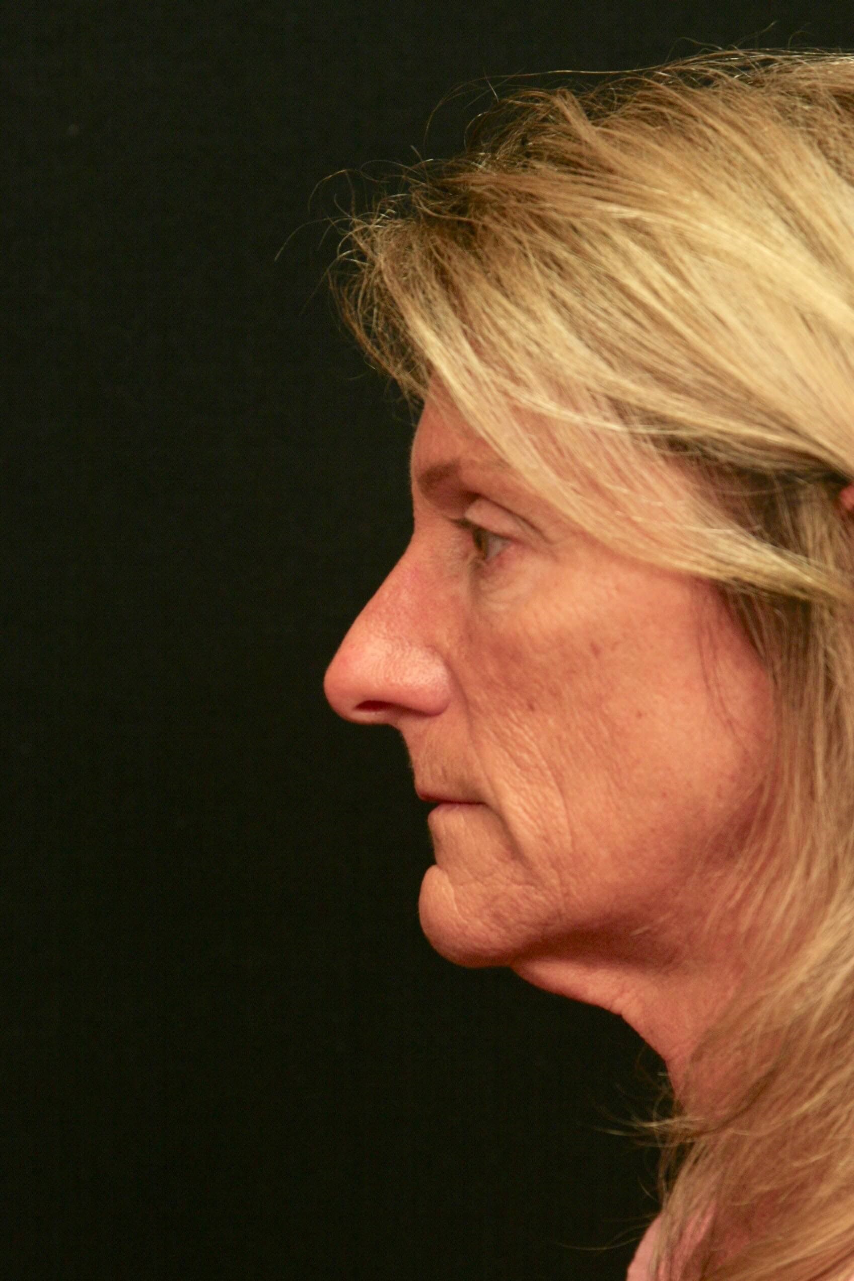Facelift Before and After Before