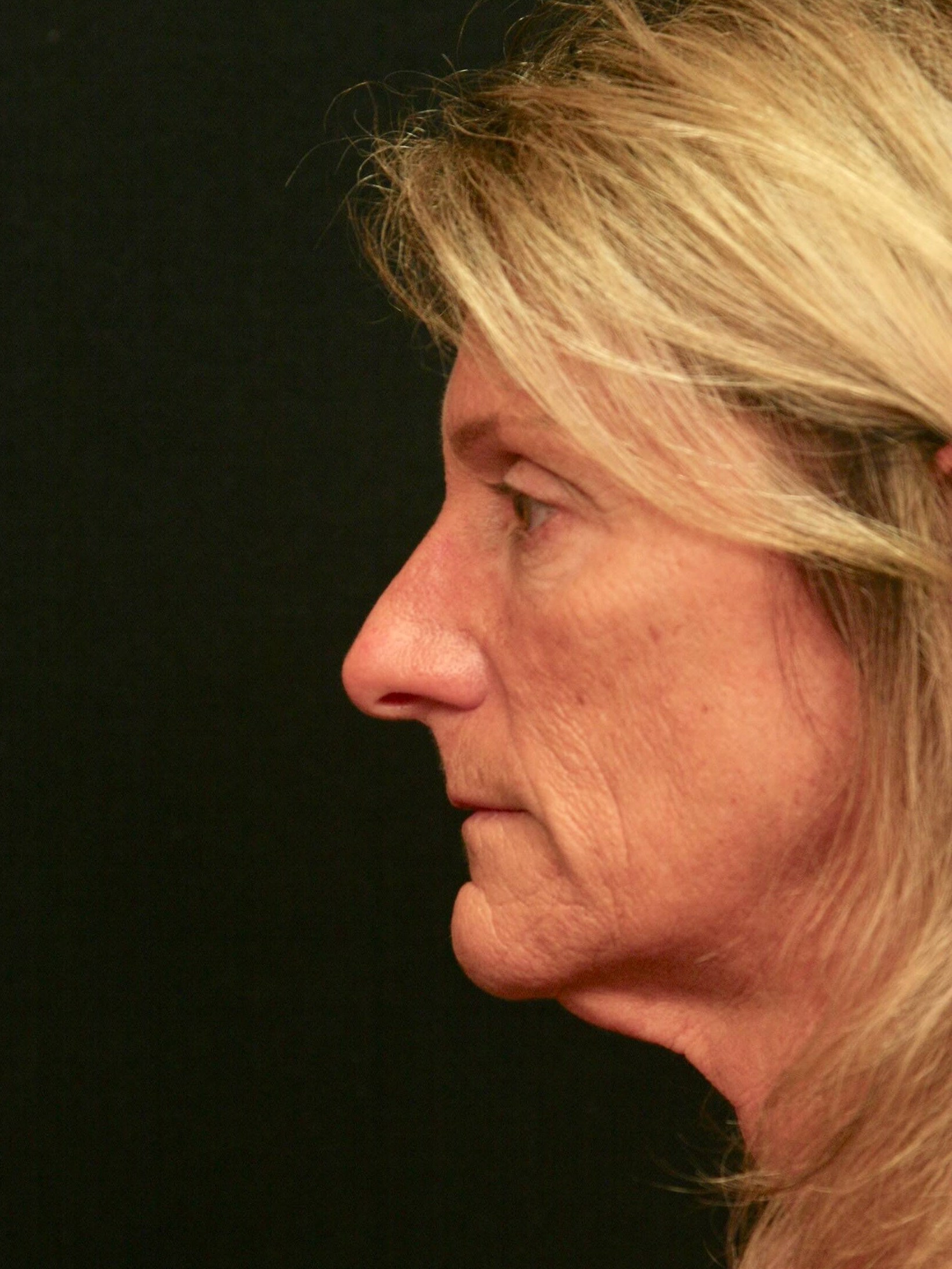 Facelift Before and After Before