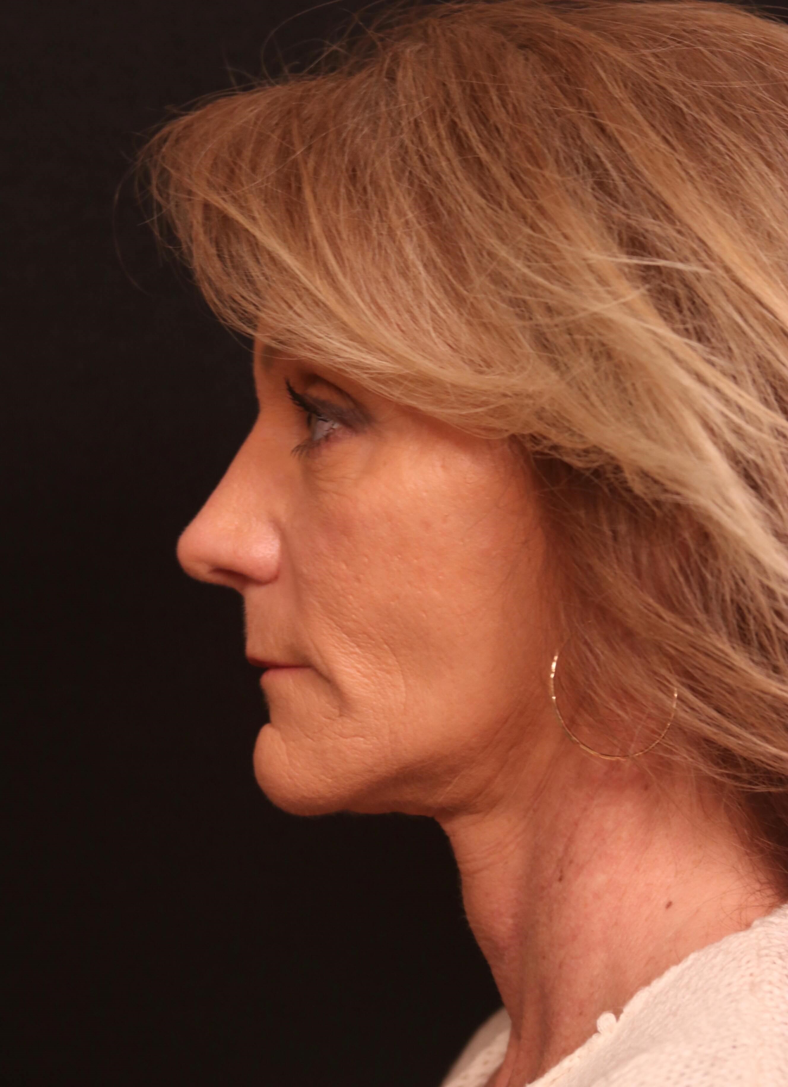 Facelift Before and After After