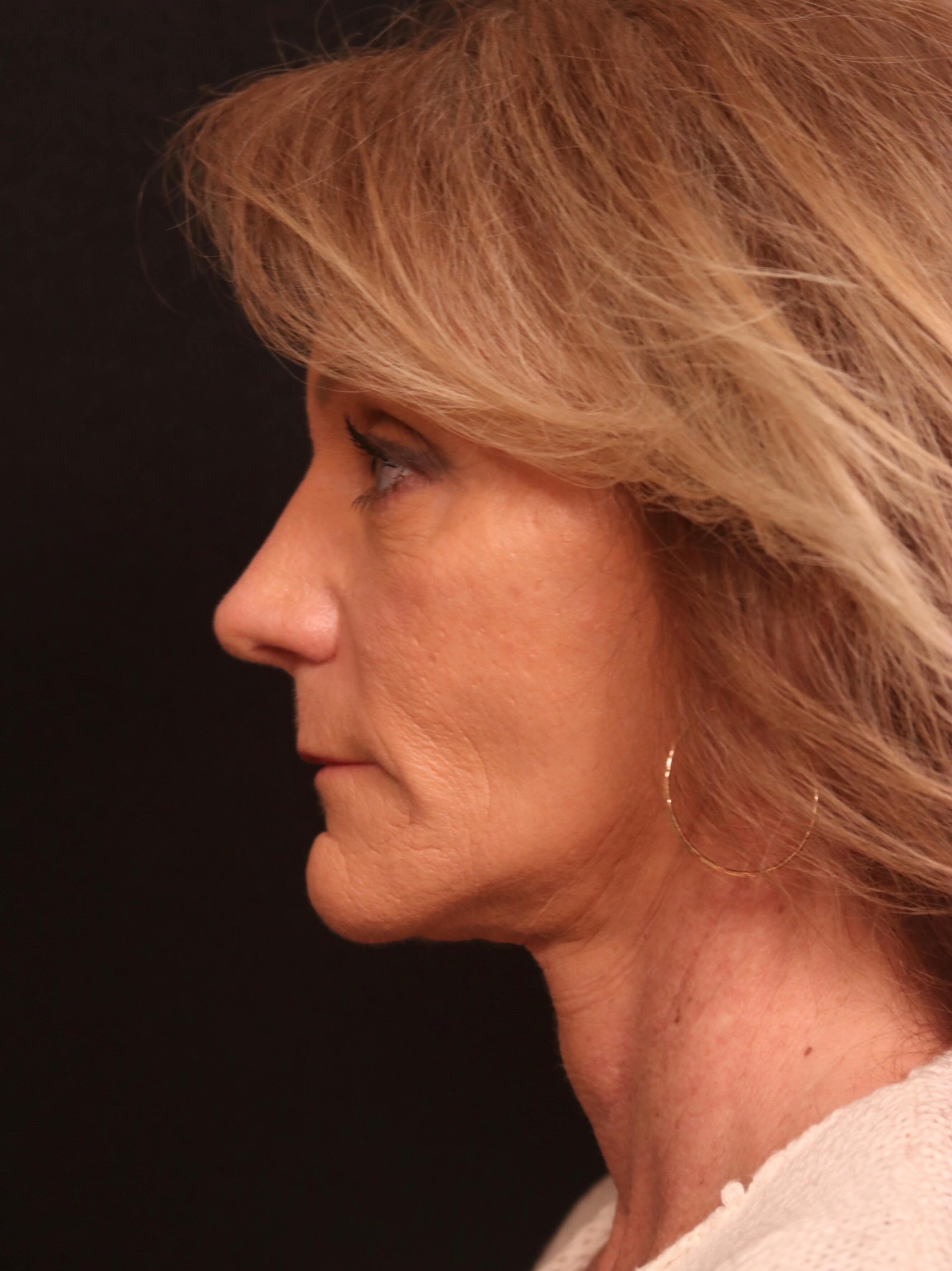 Facelift Before and After After
