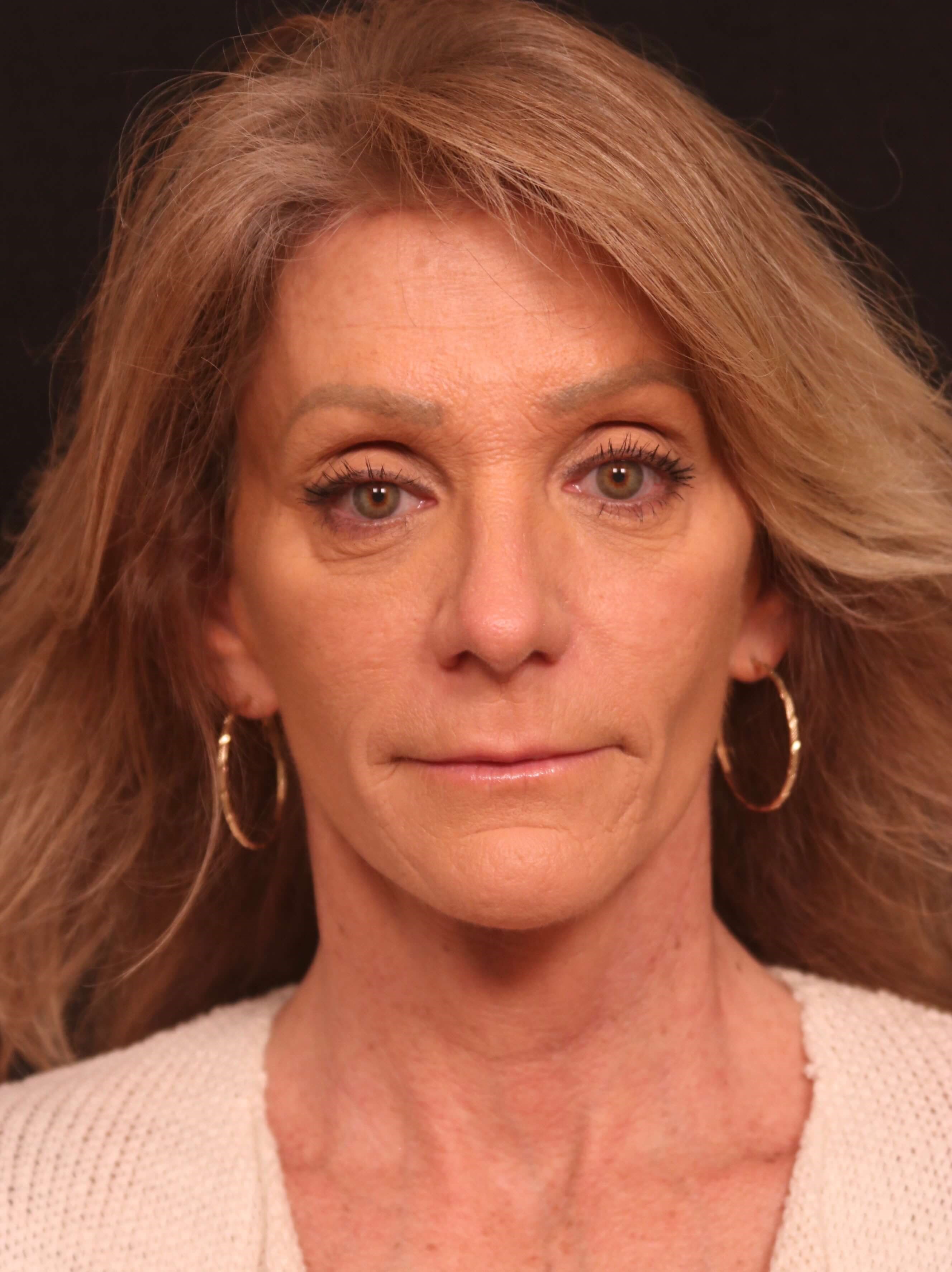 Facelift Before and After After