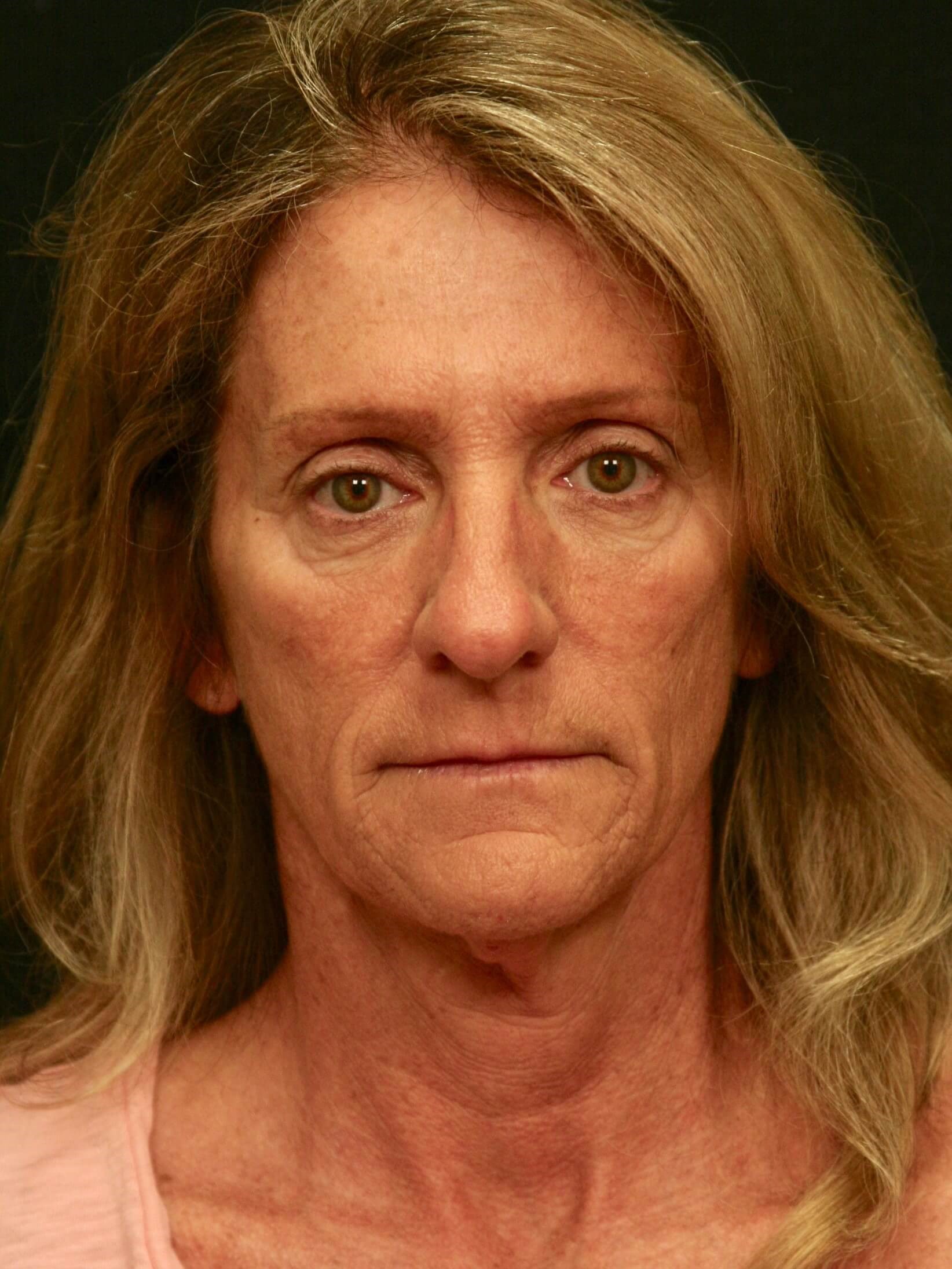 Facelift Before and After Before