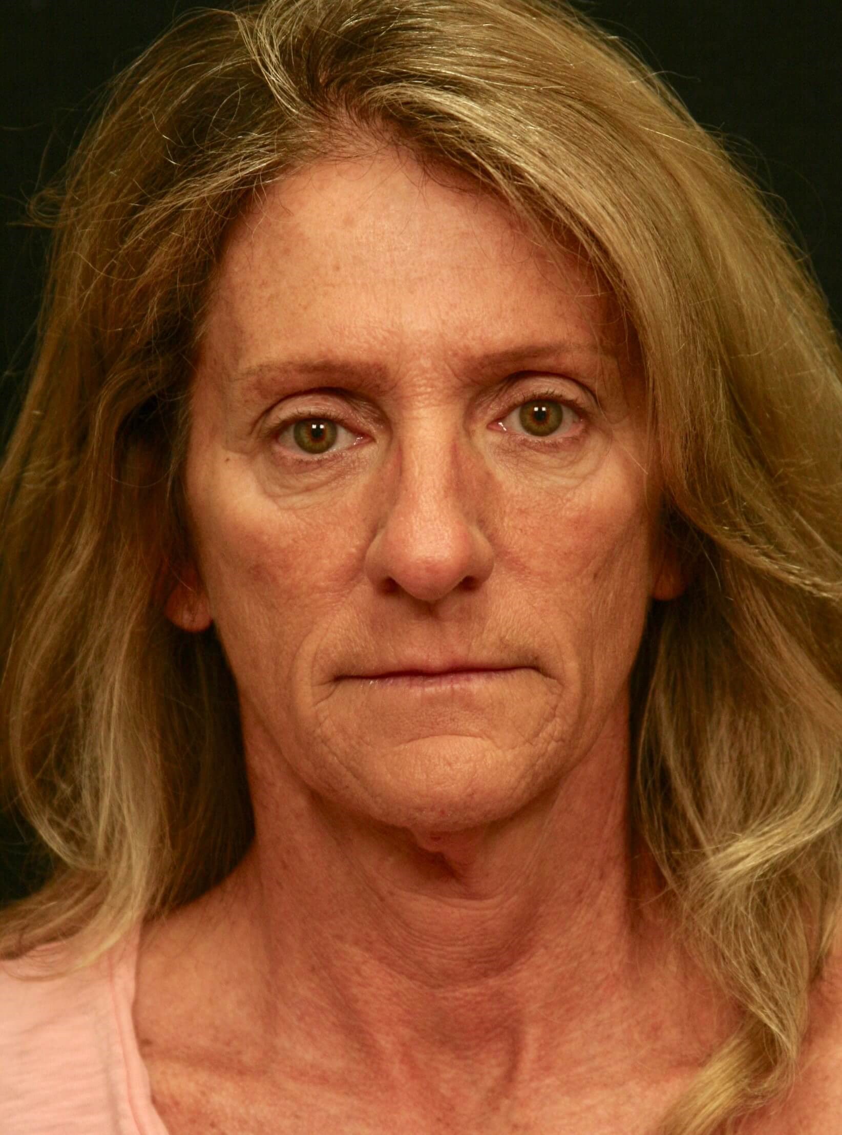 Facelift Before and After Before