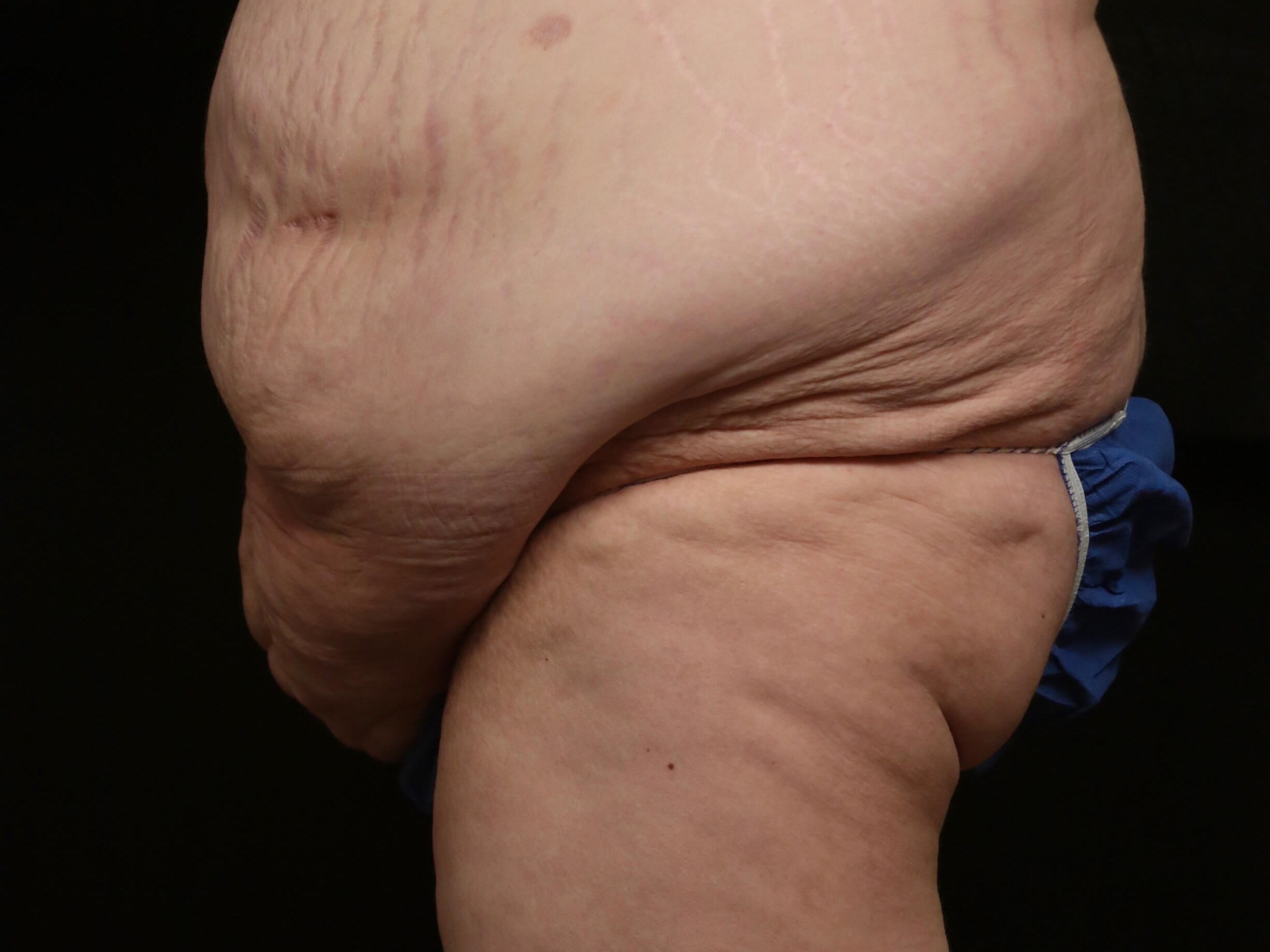 Tummy Tuck Before and After Before