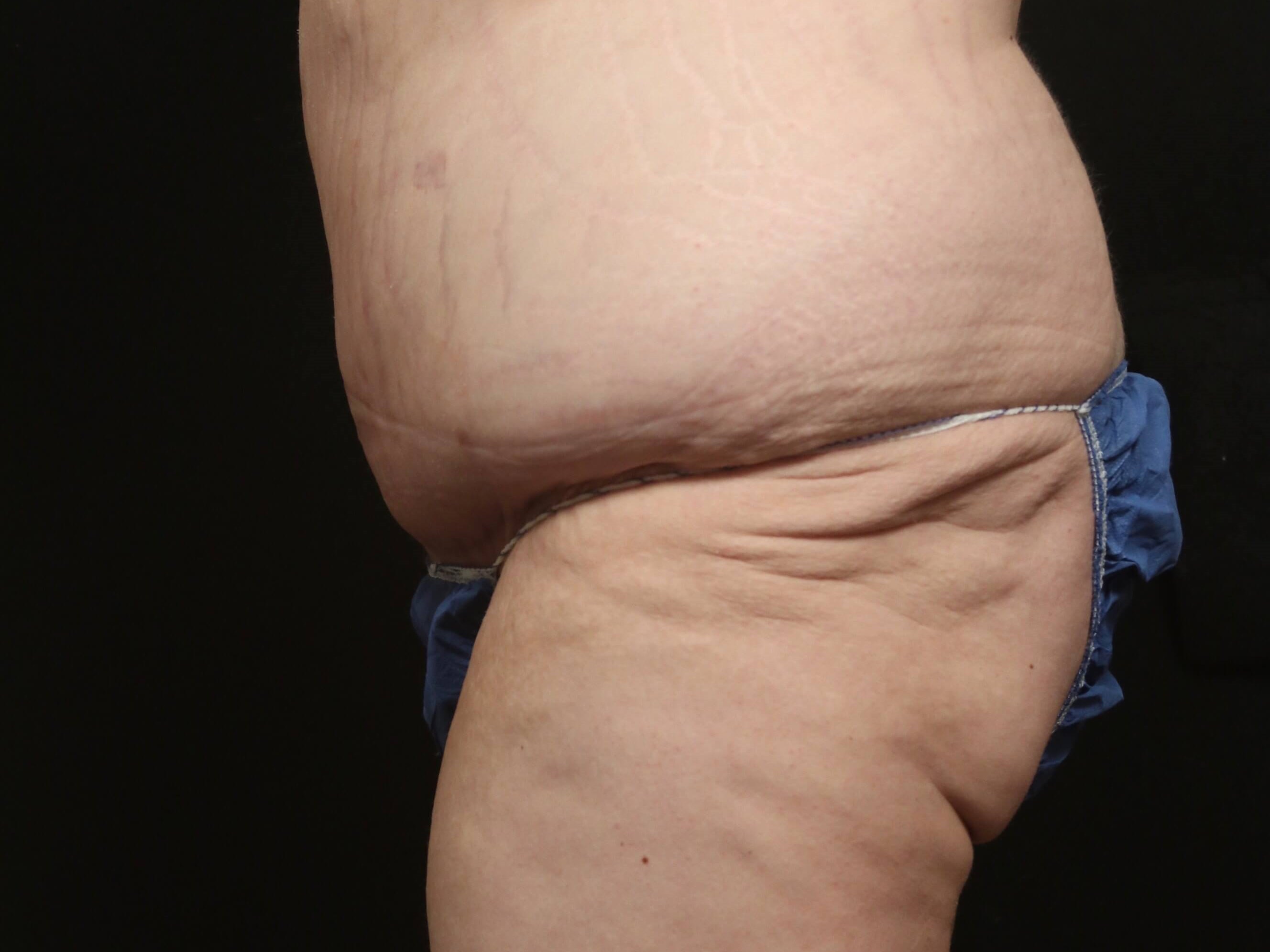 Tummy Tuck Before and After After