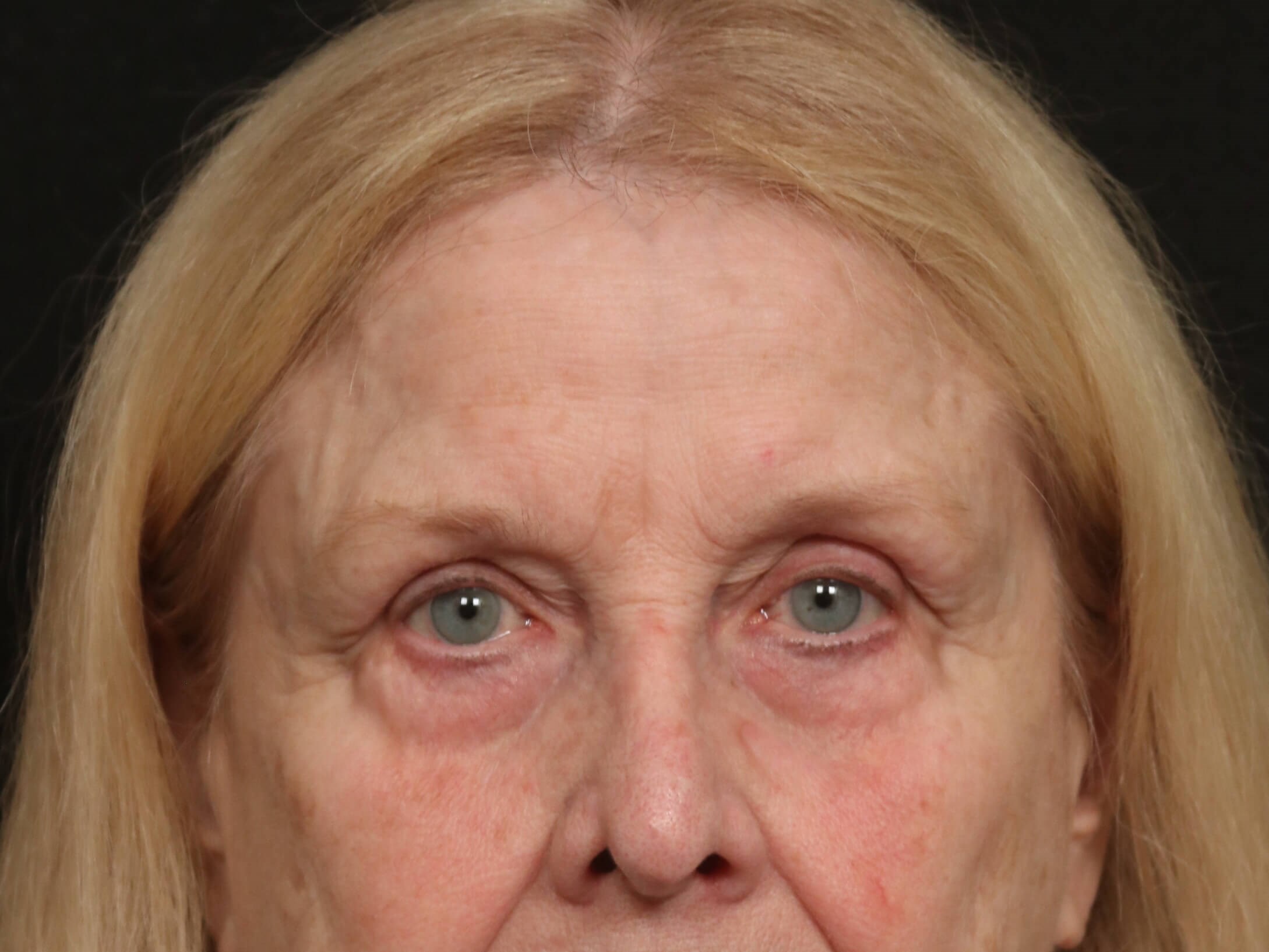 Forehead Lift Before and After Before
