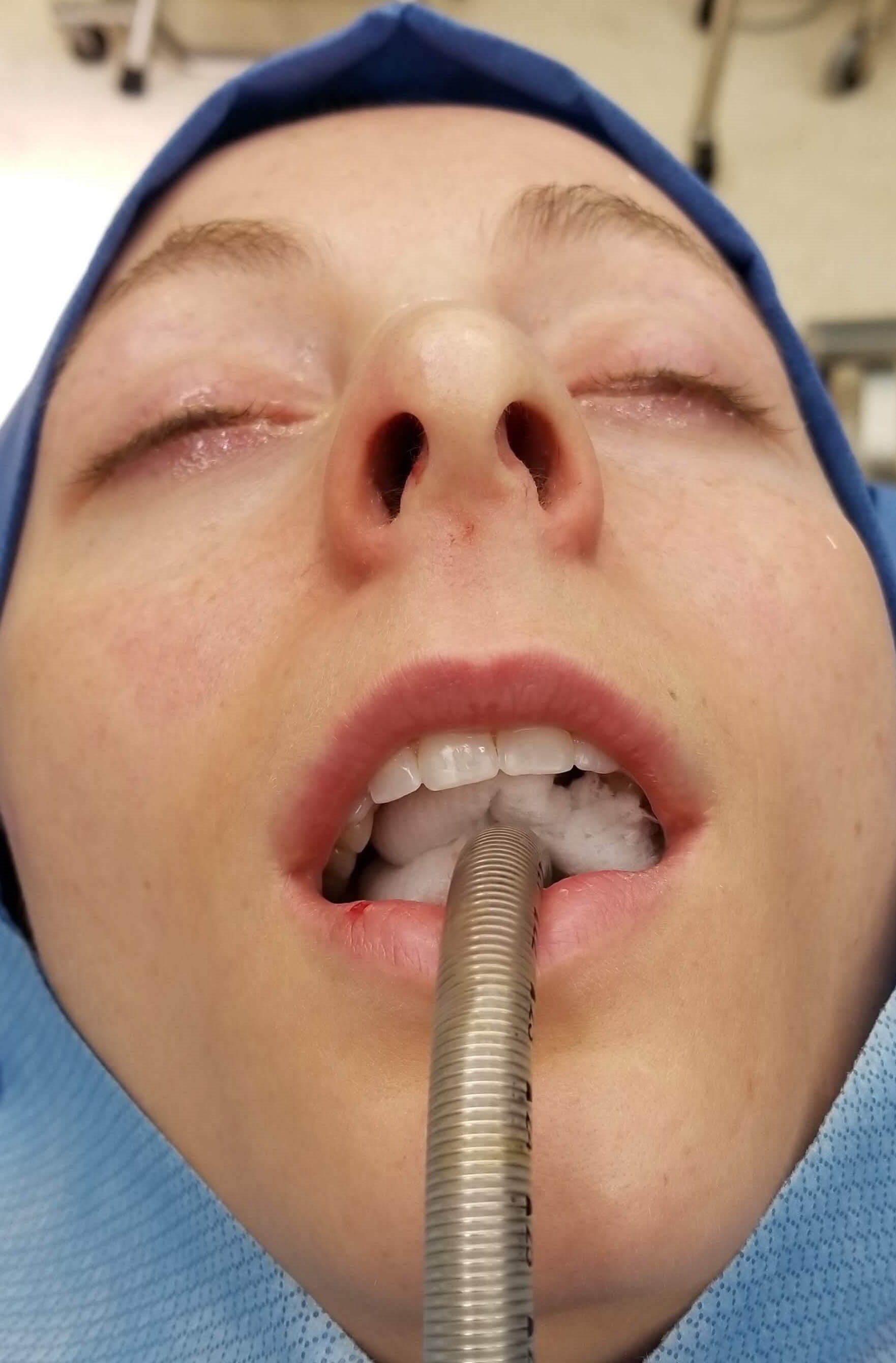 Rhinoplasty Before and After Before