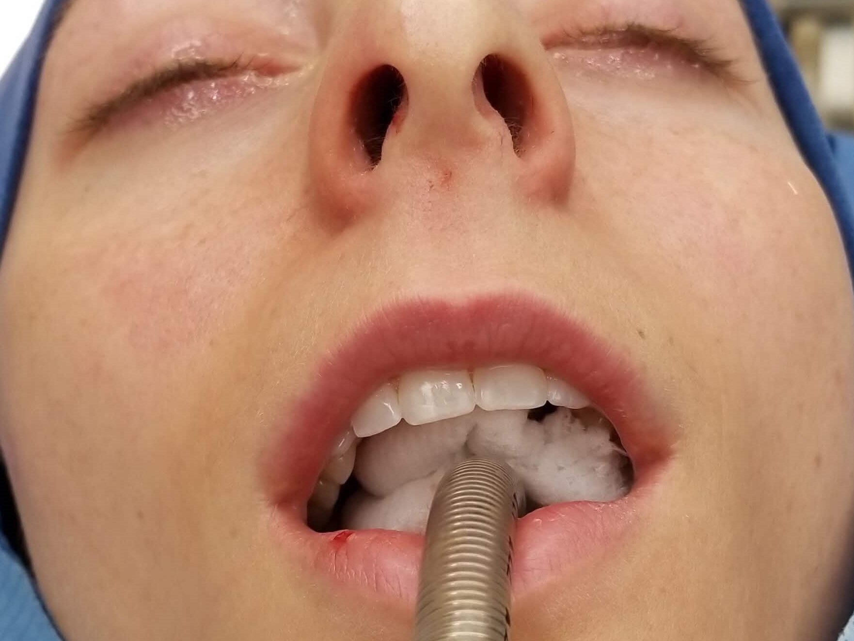 Rhinoplasty Before and After Before