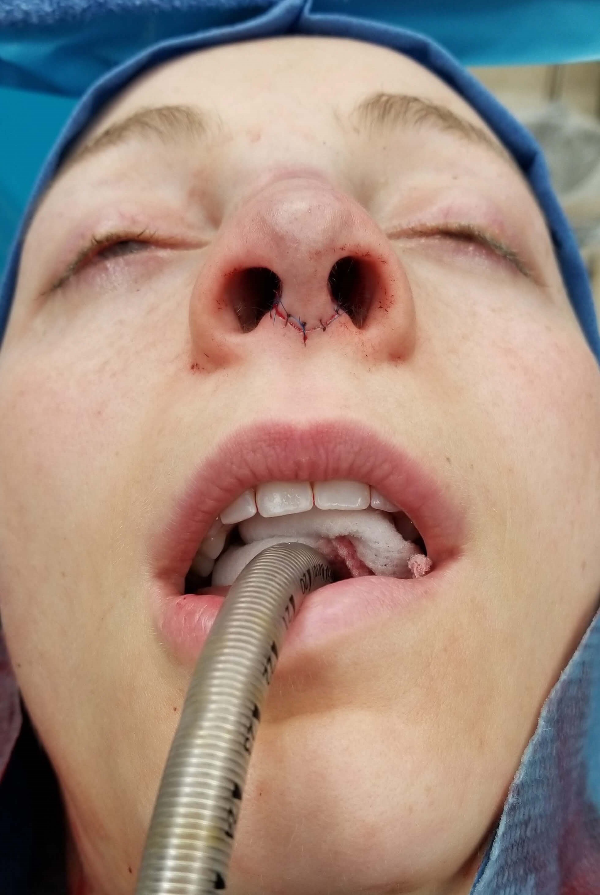 Rhinoplasty Before and After After