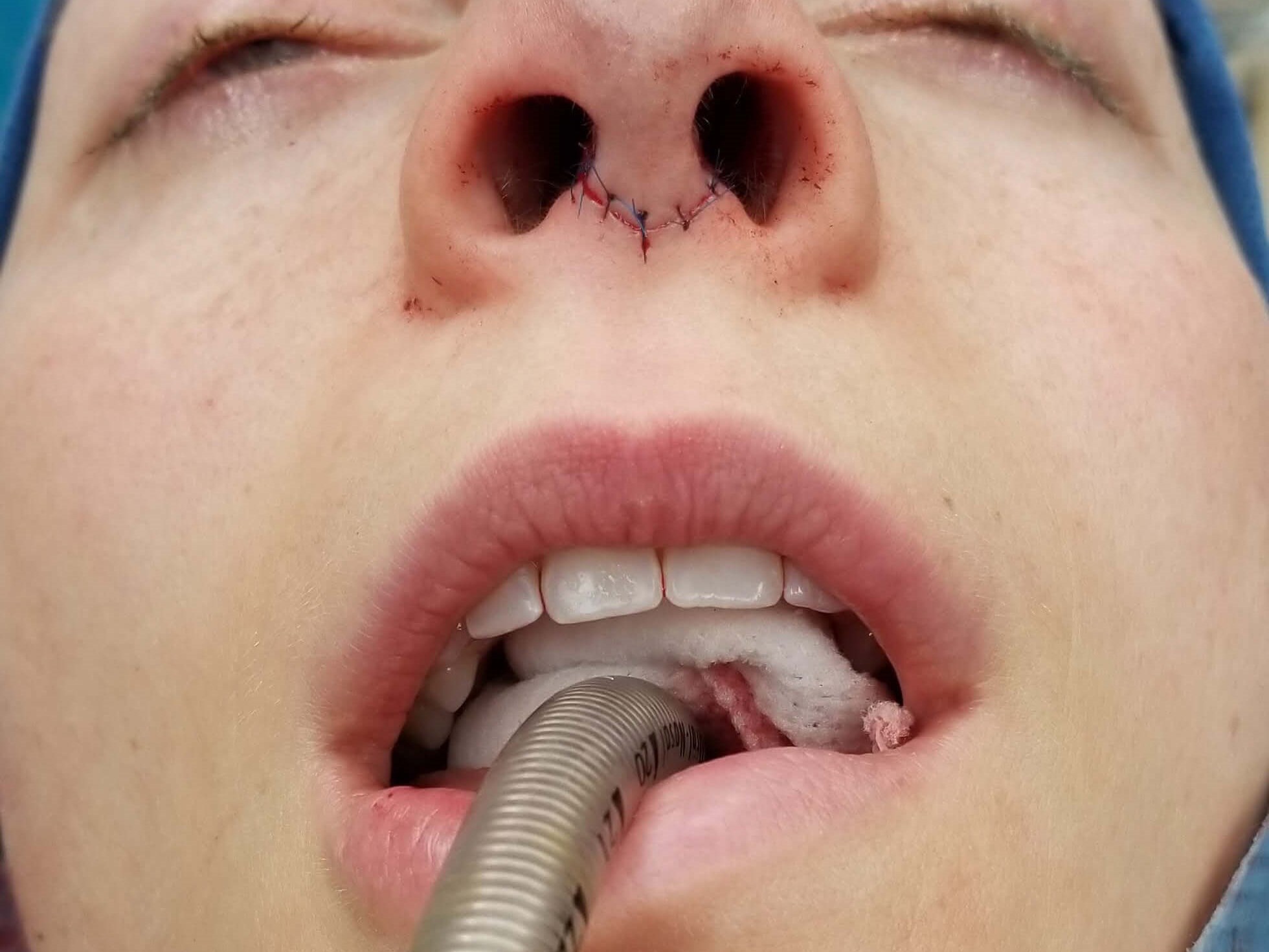 Rhinoplasty Before and After After