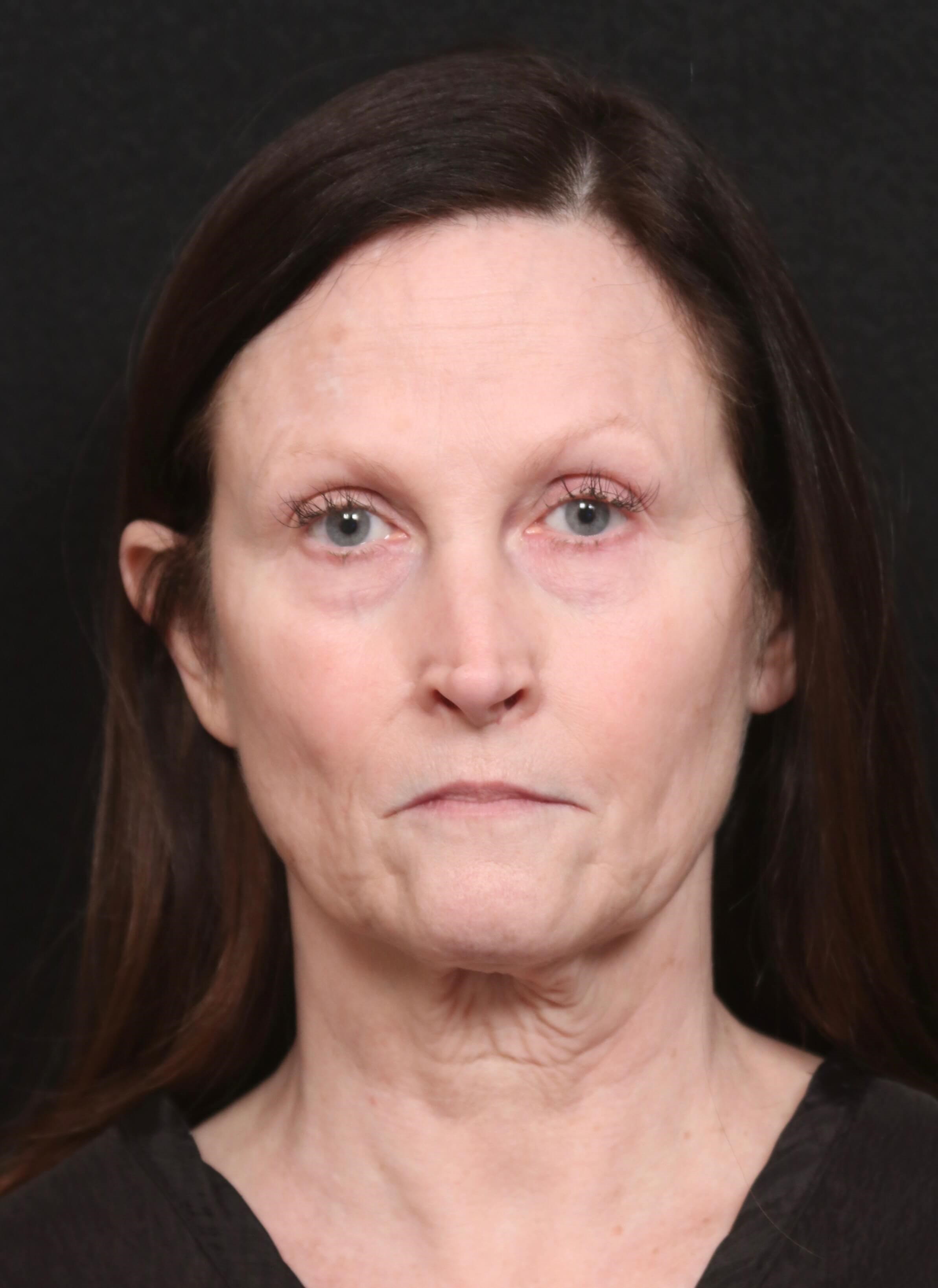 Facelift Before and After Before