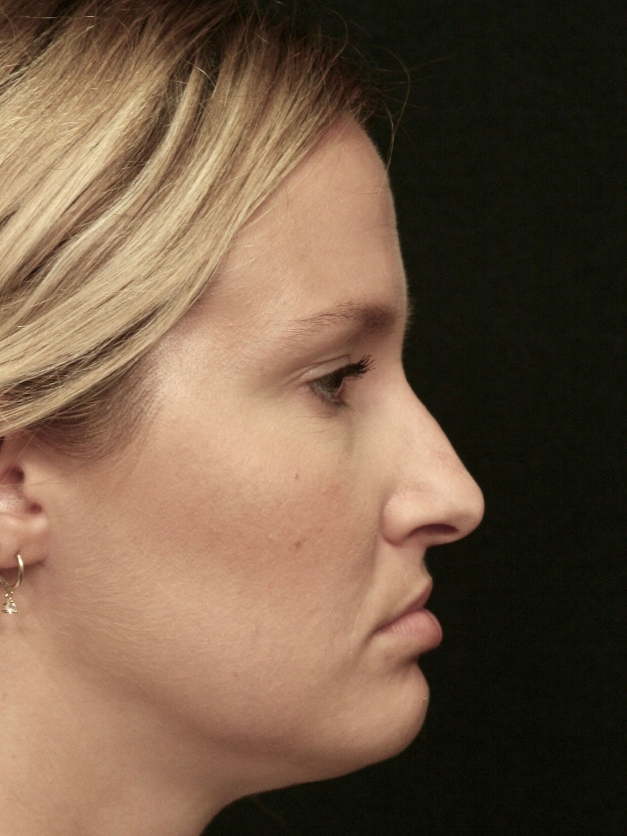 Rhinoplasty Before and After Before