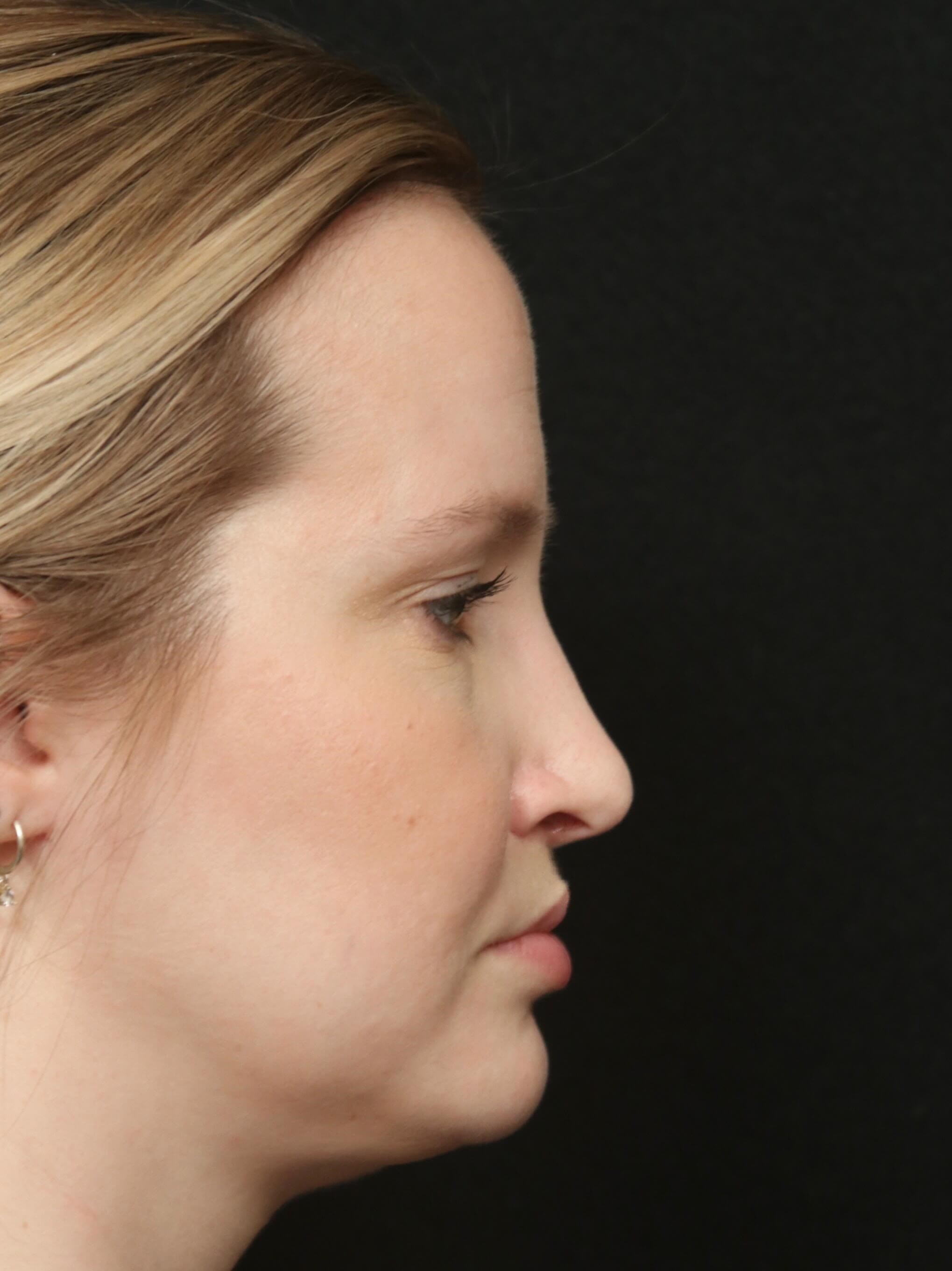 Rhinoplasty Before and After After