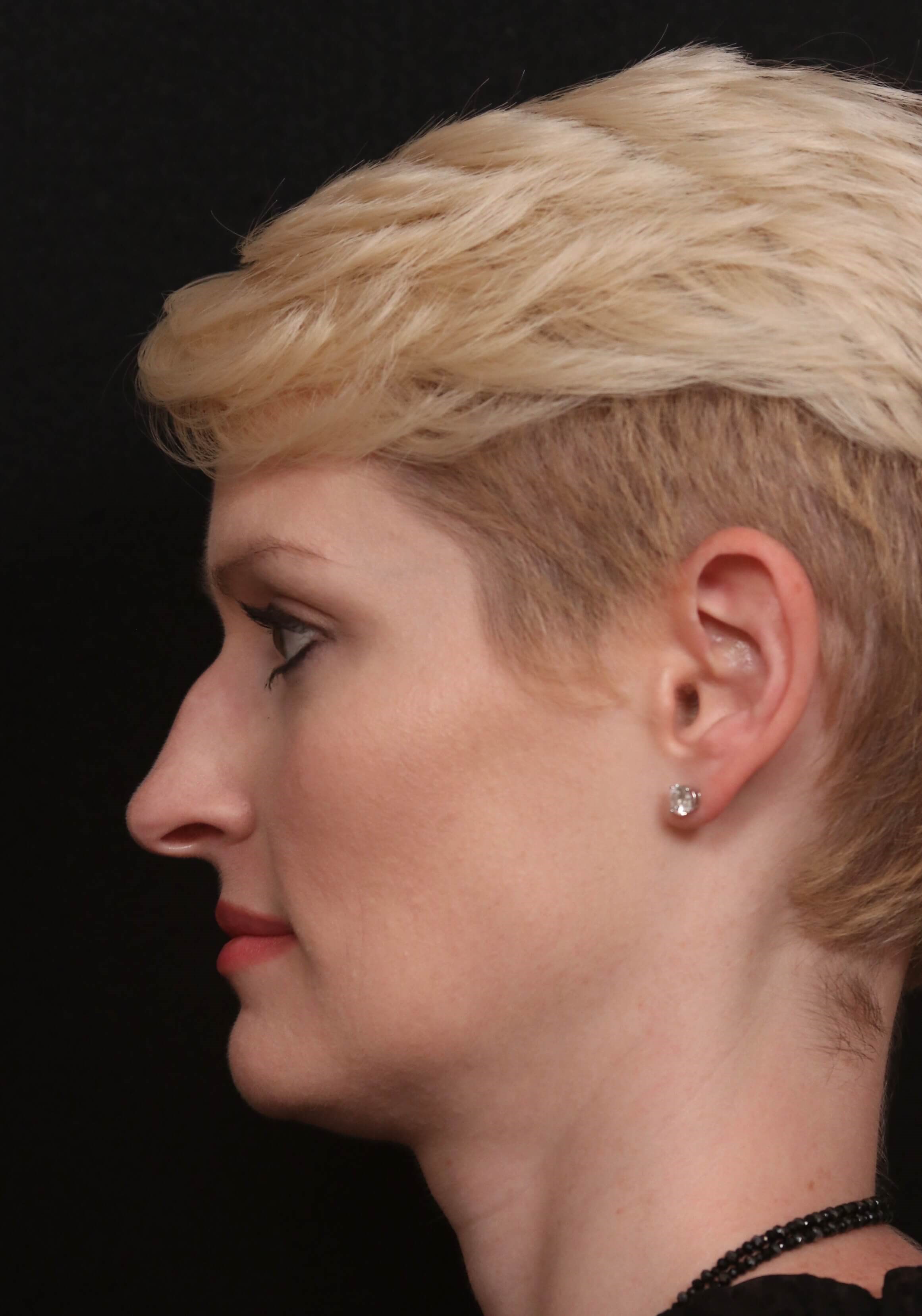 Before & After Rhinoplasty Before