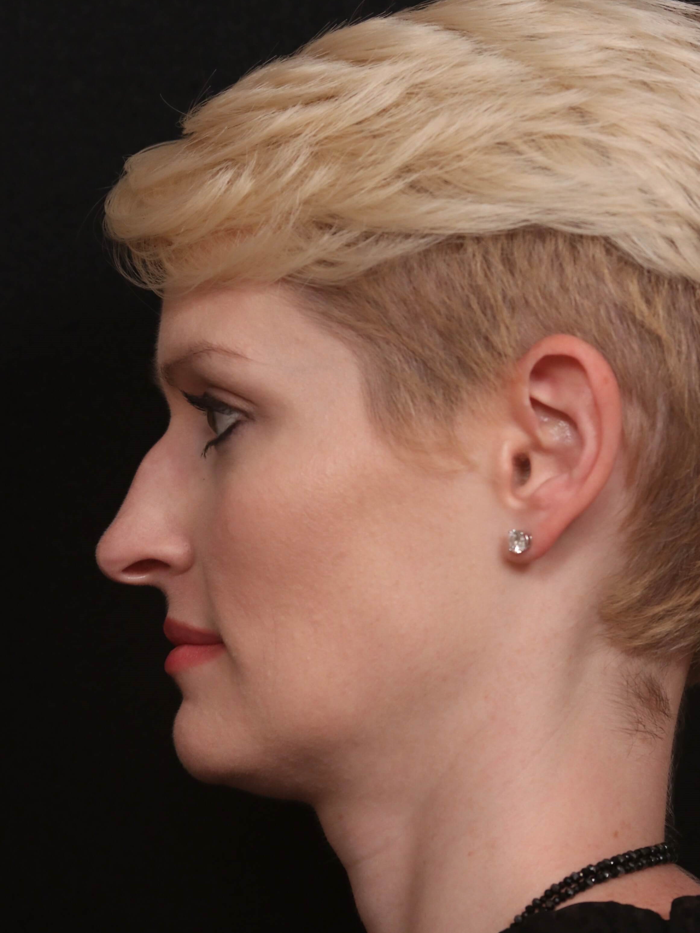 Before & After Rhinoplasty Before