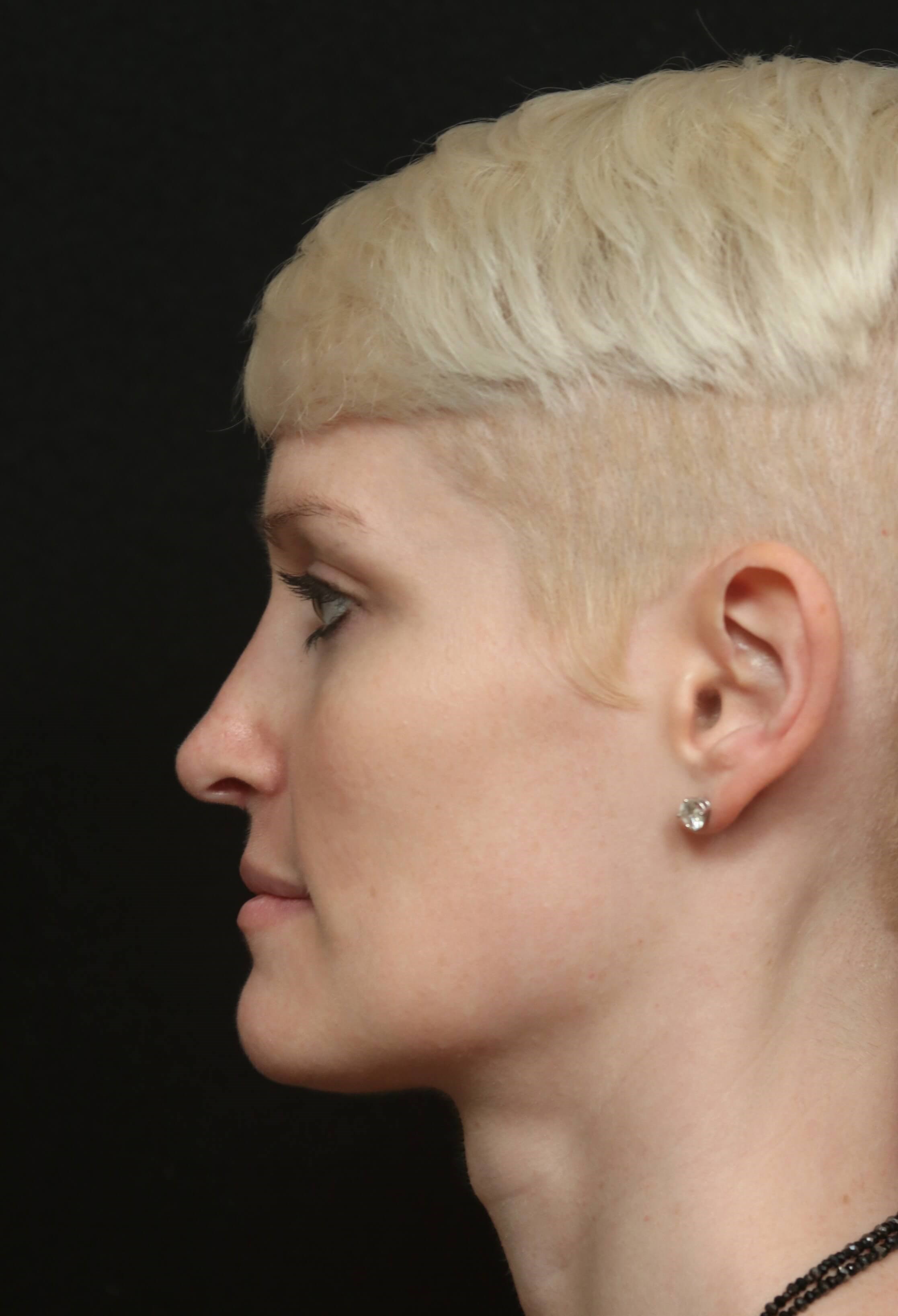 Before & After Rhinoplasty After