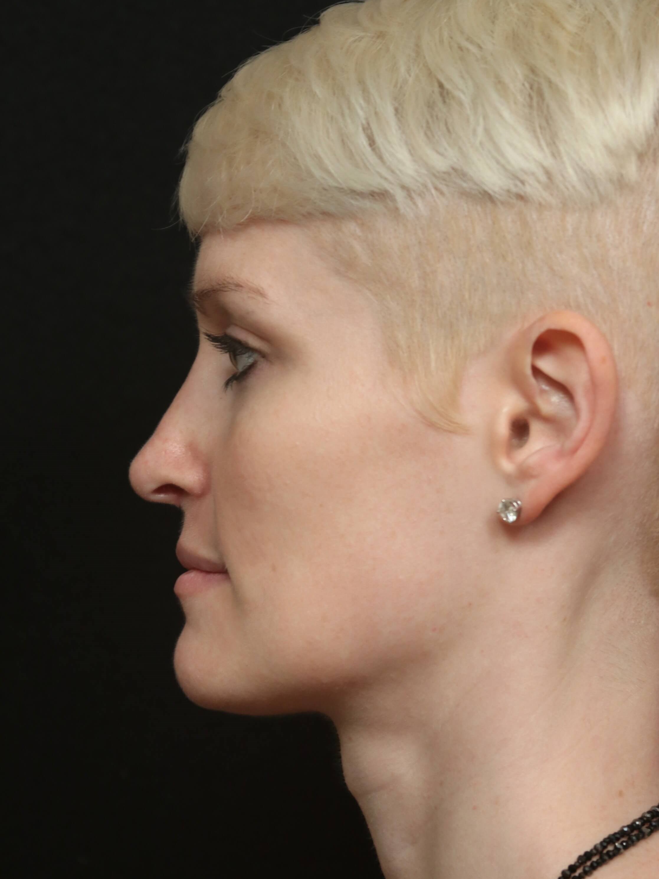 Before & After Rhinoplasty After