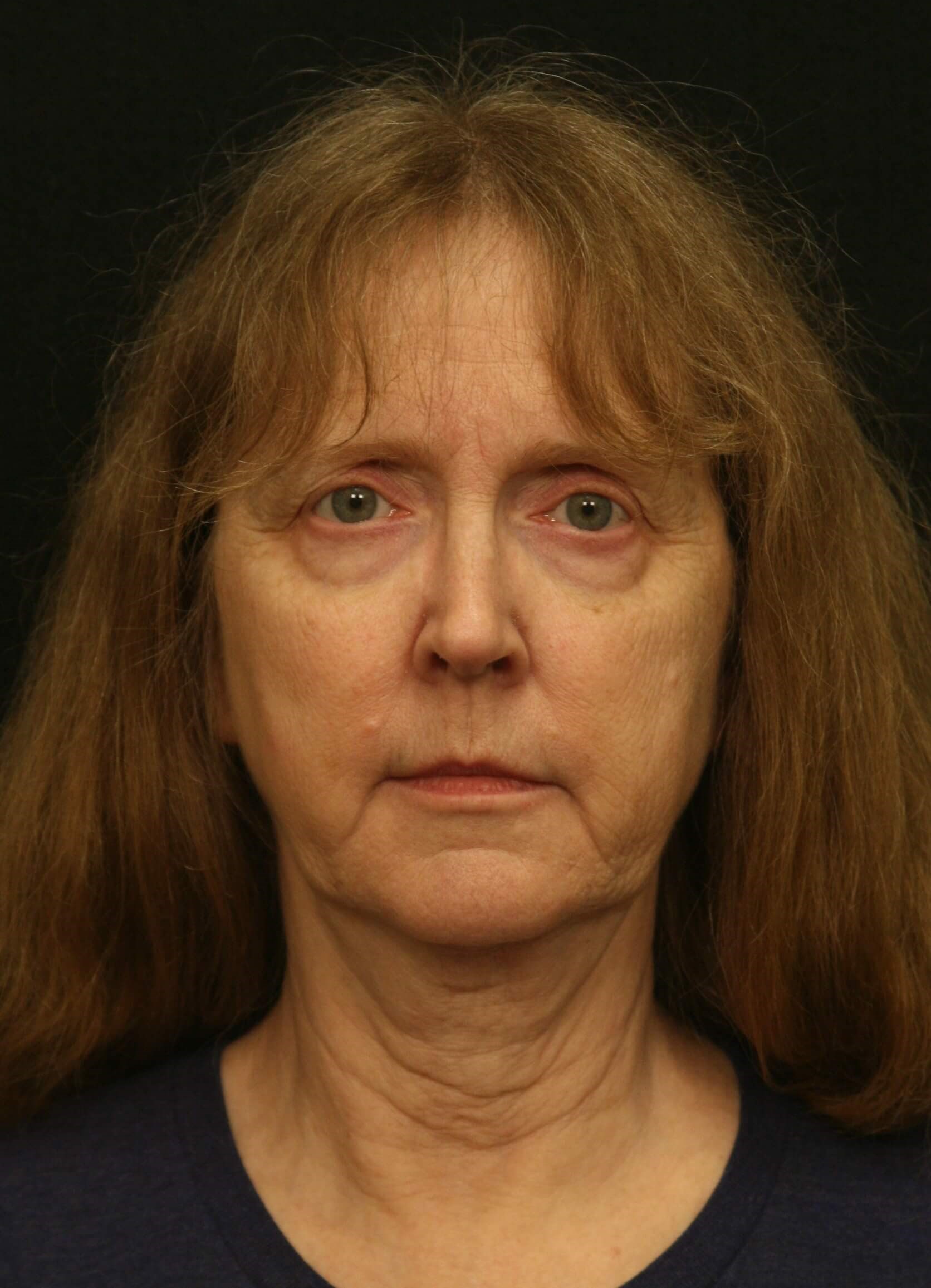 Facelift Before and After Before