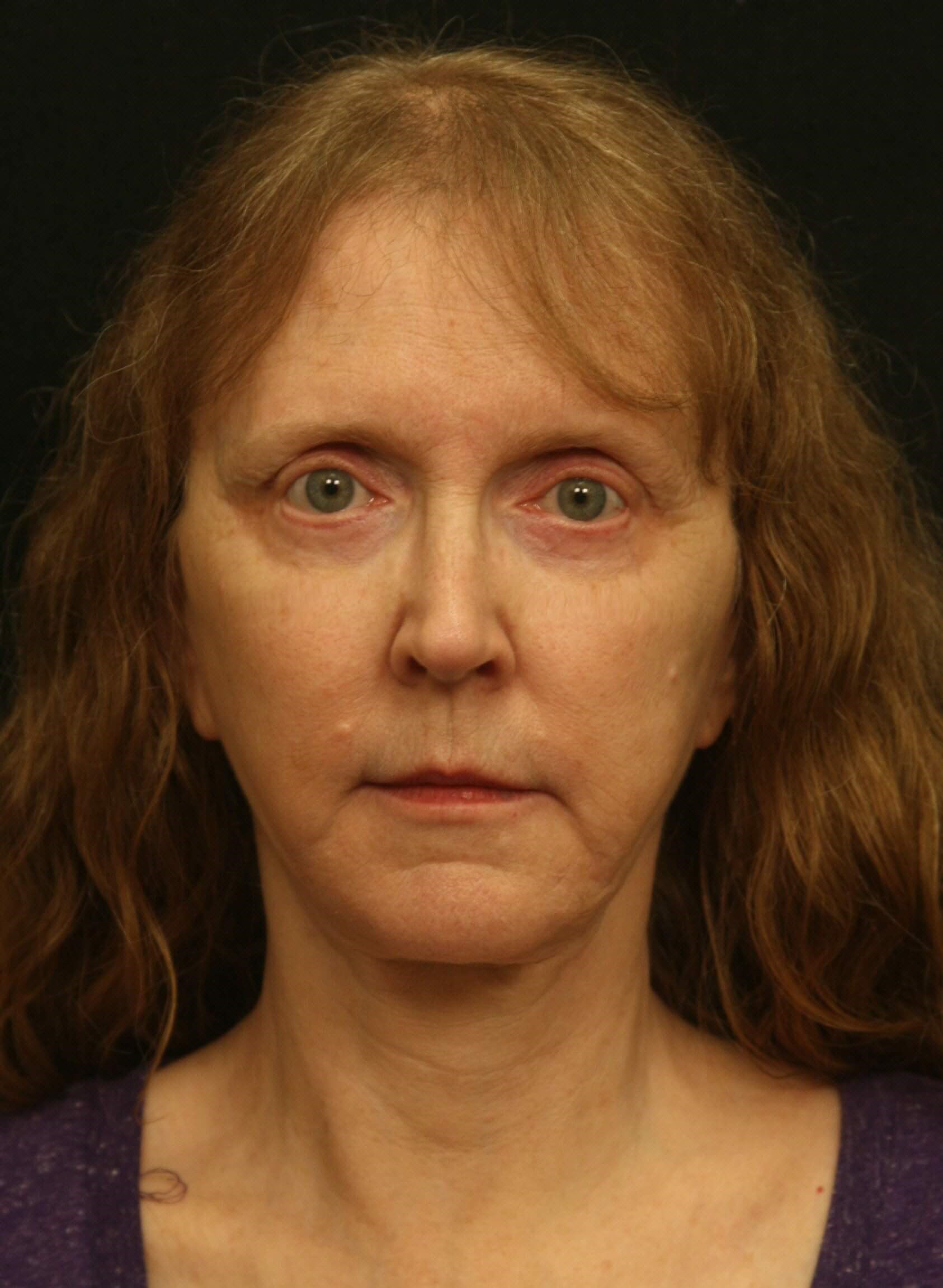 Facelift Before and After After