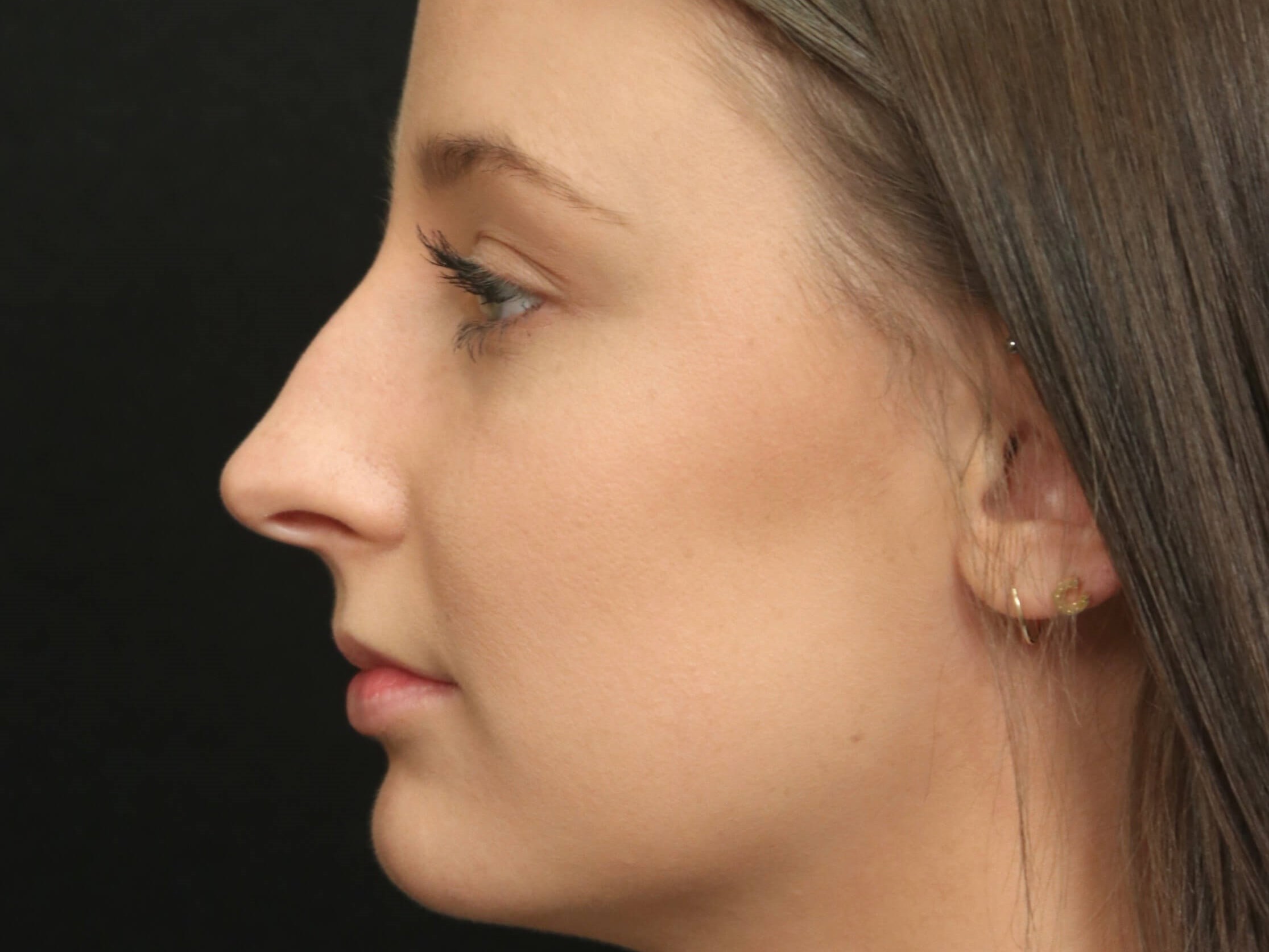 Rhinoplasty Results Dallas Before