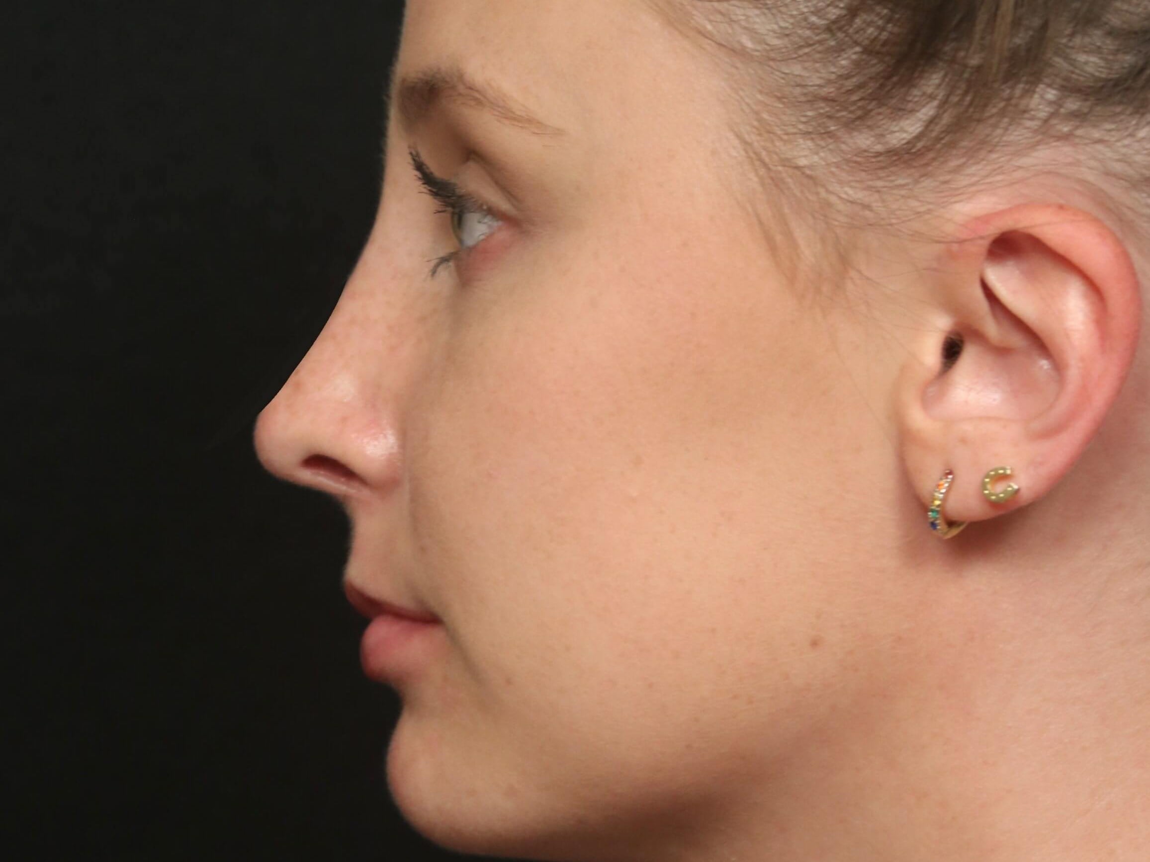 Rhinoplasty Results Dallas After