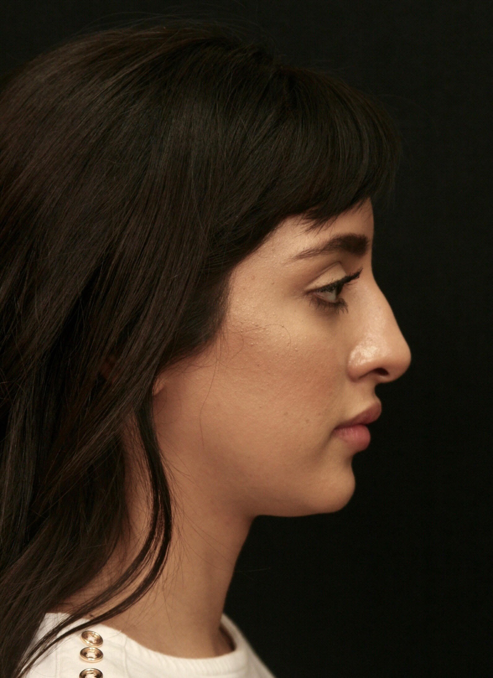 Before and After Rhinoplasty Before