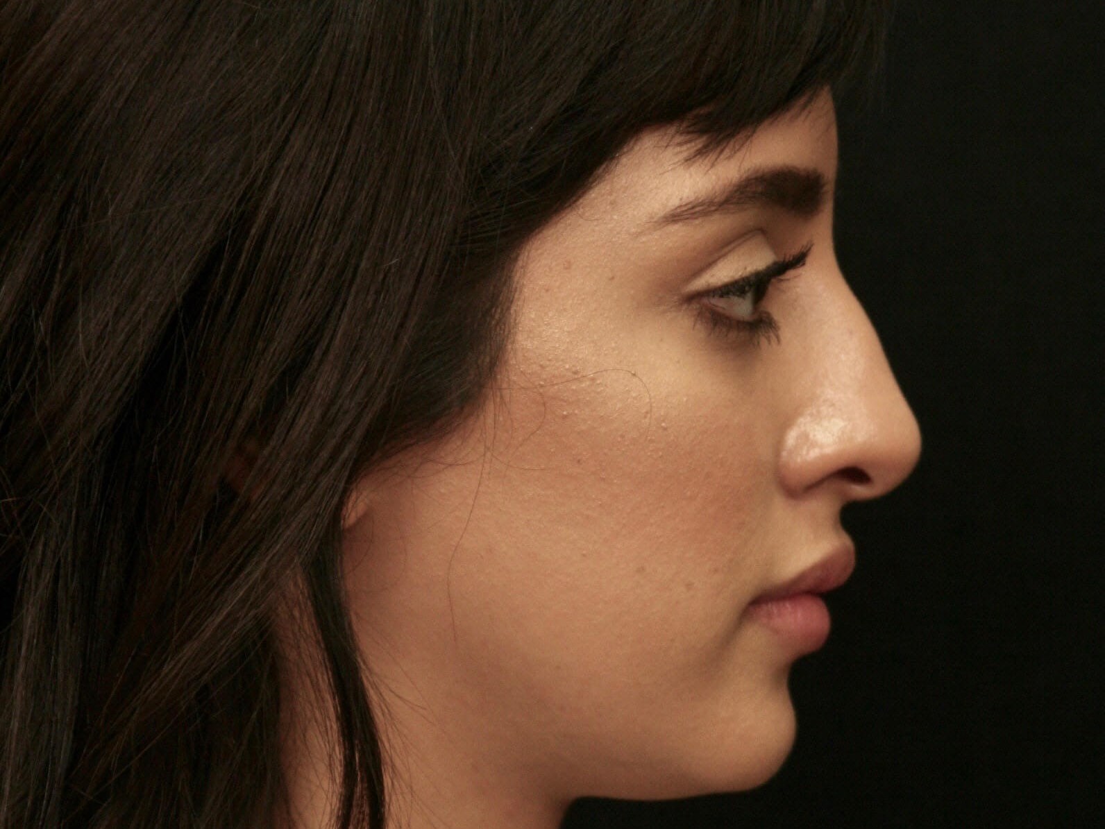 Before and After Rhinoplasty Before