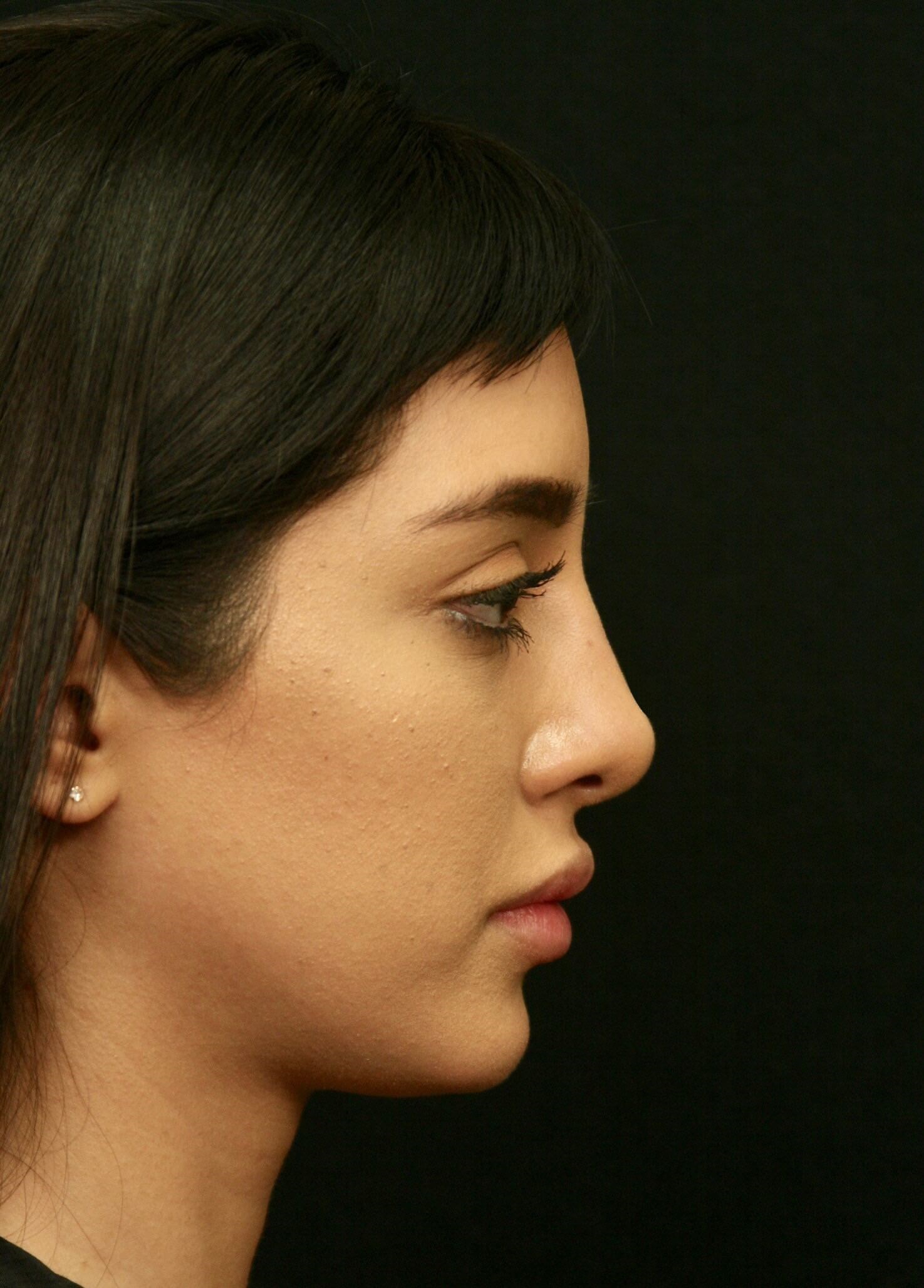 Before and After Rhinoplasty After