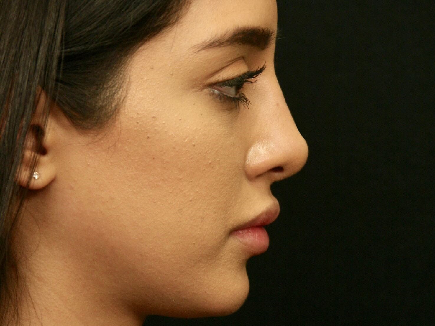 Before and After Rhinoplasty After