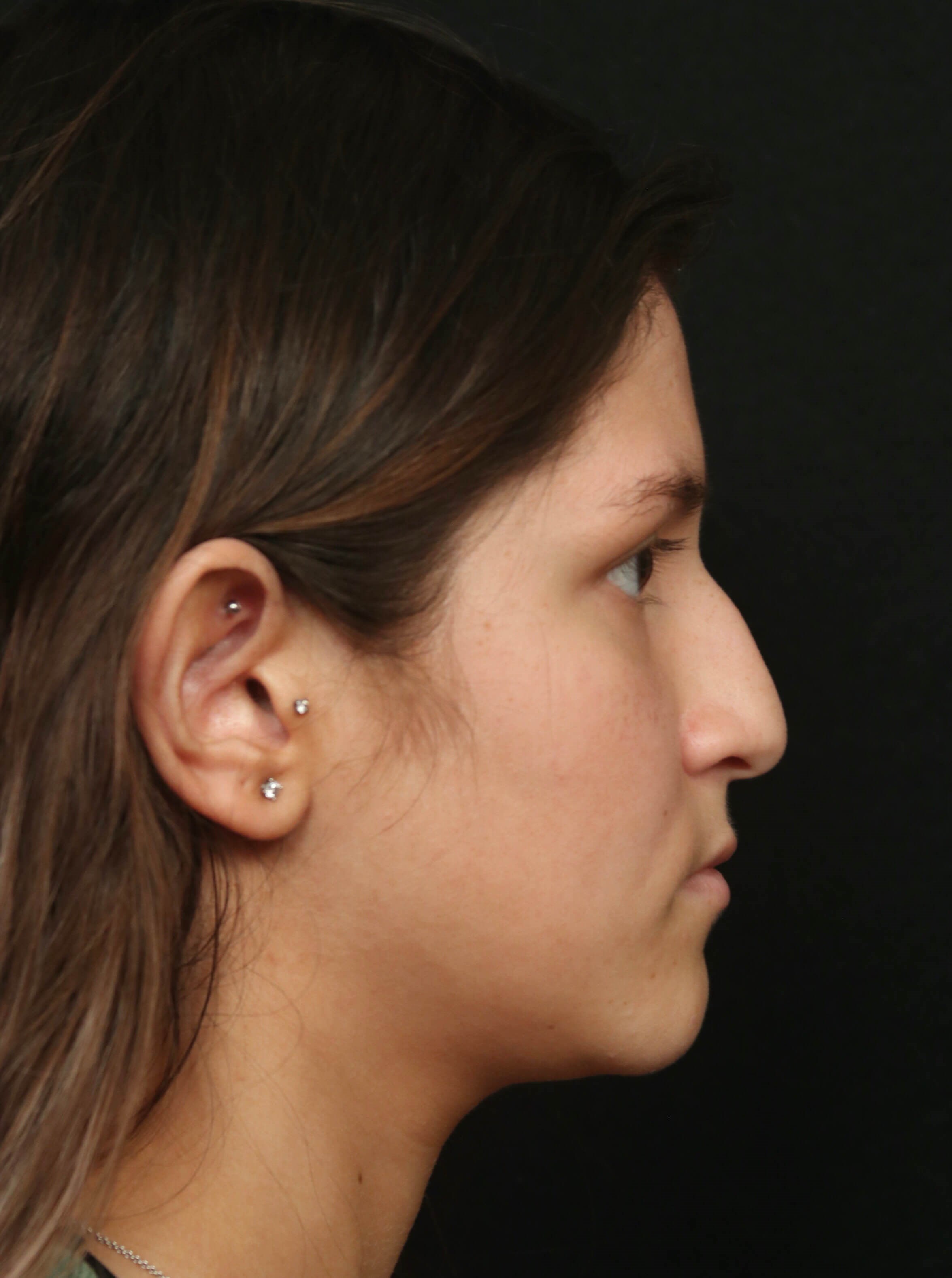 Rhinoplasty Before and After Before