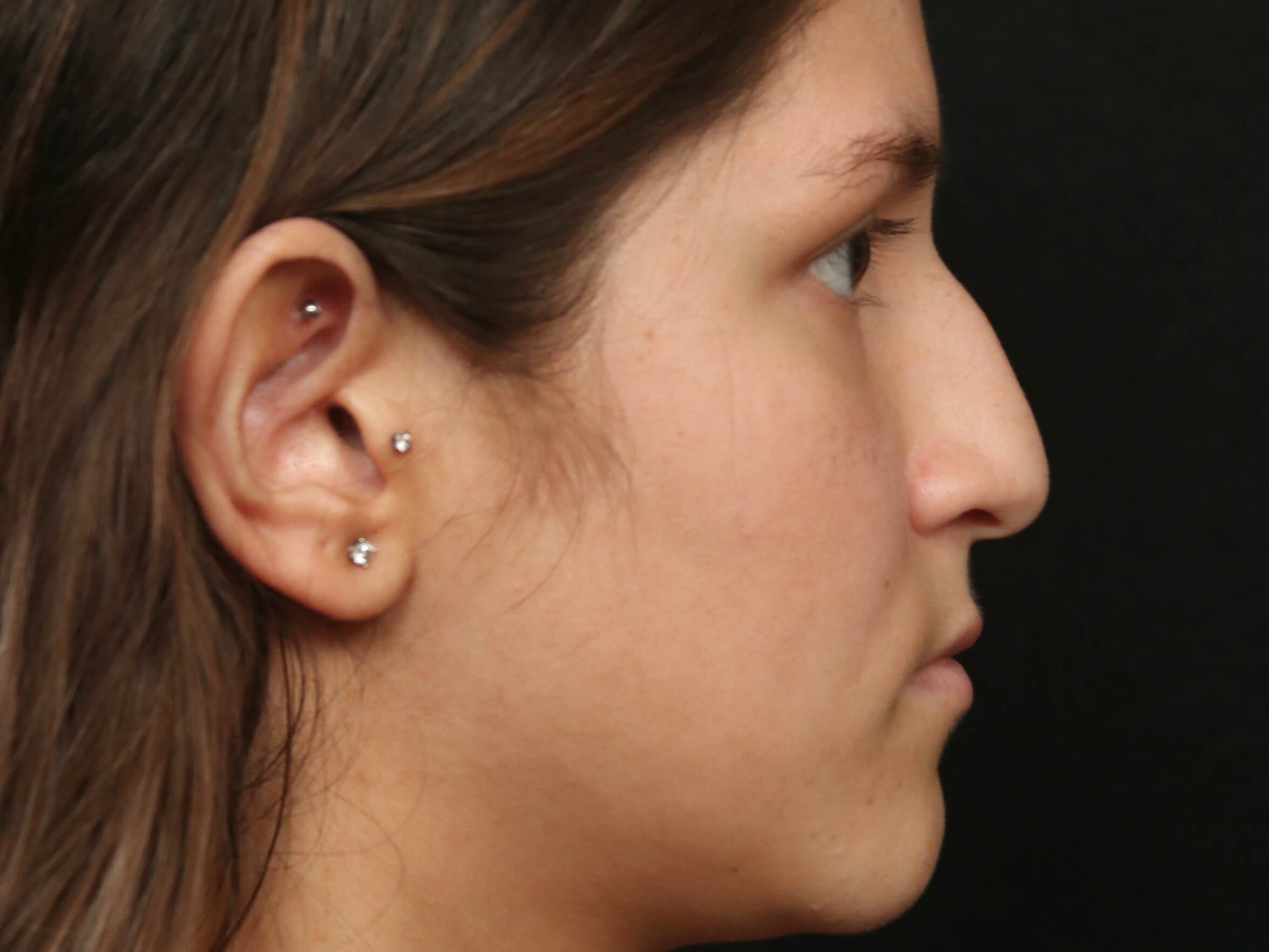 Rhinoplasty Before and After Before