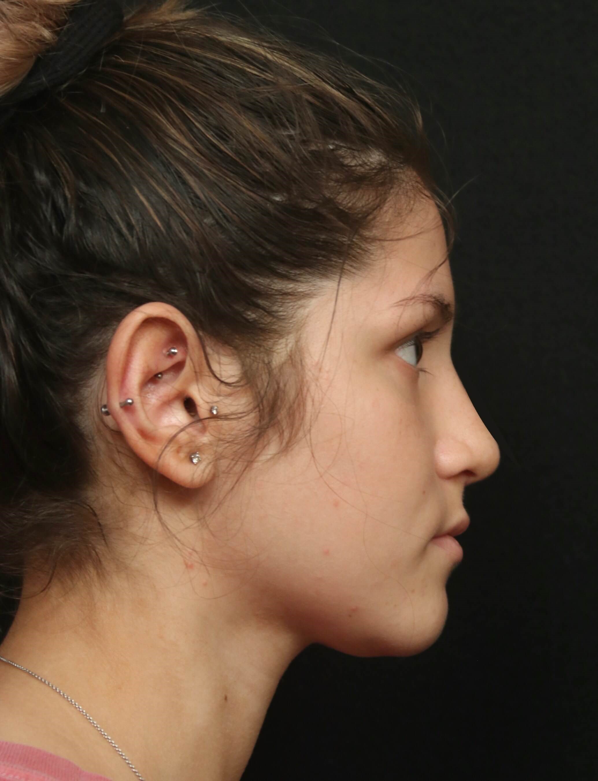 Rhinoplasty Before and After After
