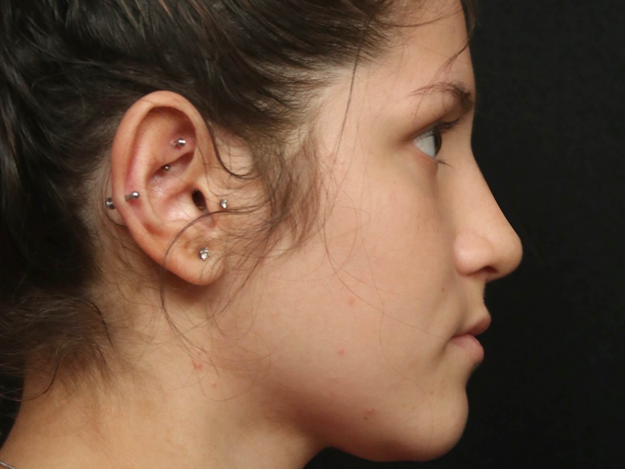 Rhinoplasty Before and After After