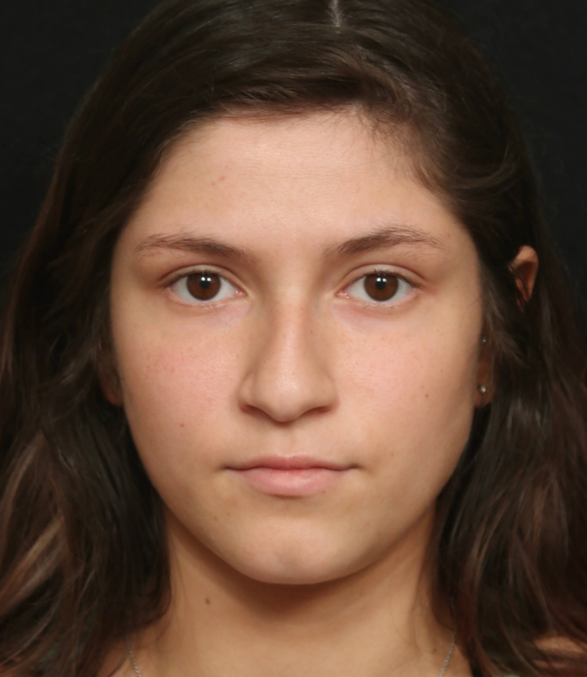 Rhinoplasty Before and After Before