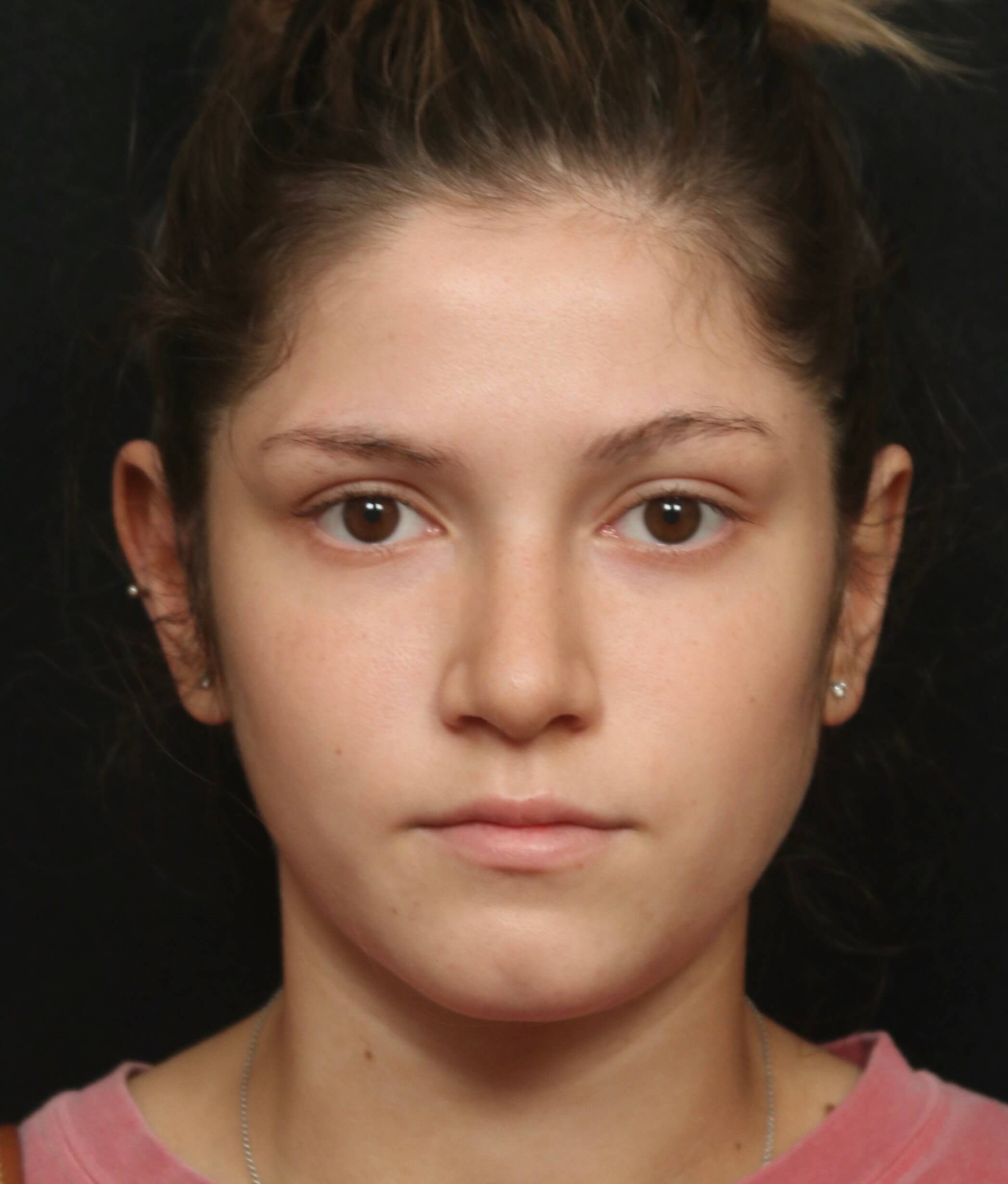 Rhinoplasty Before and After After
