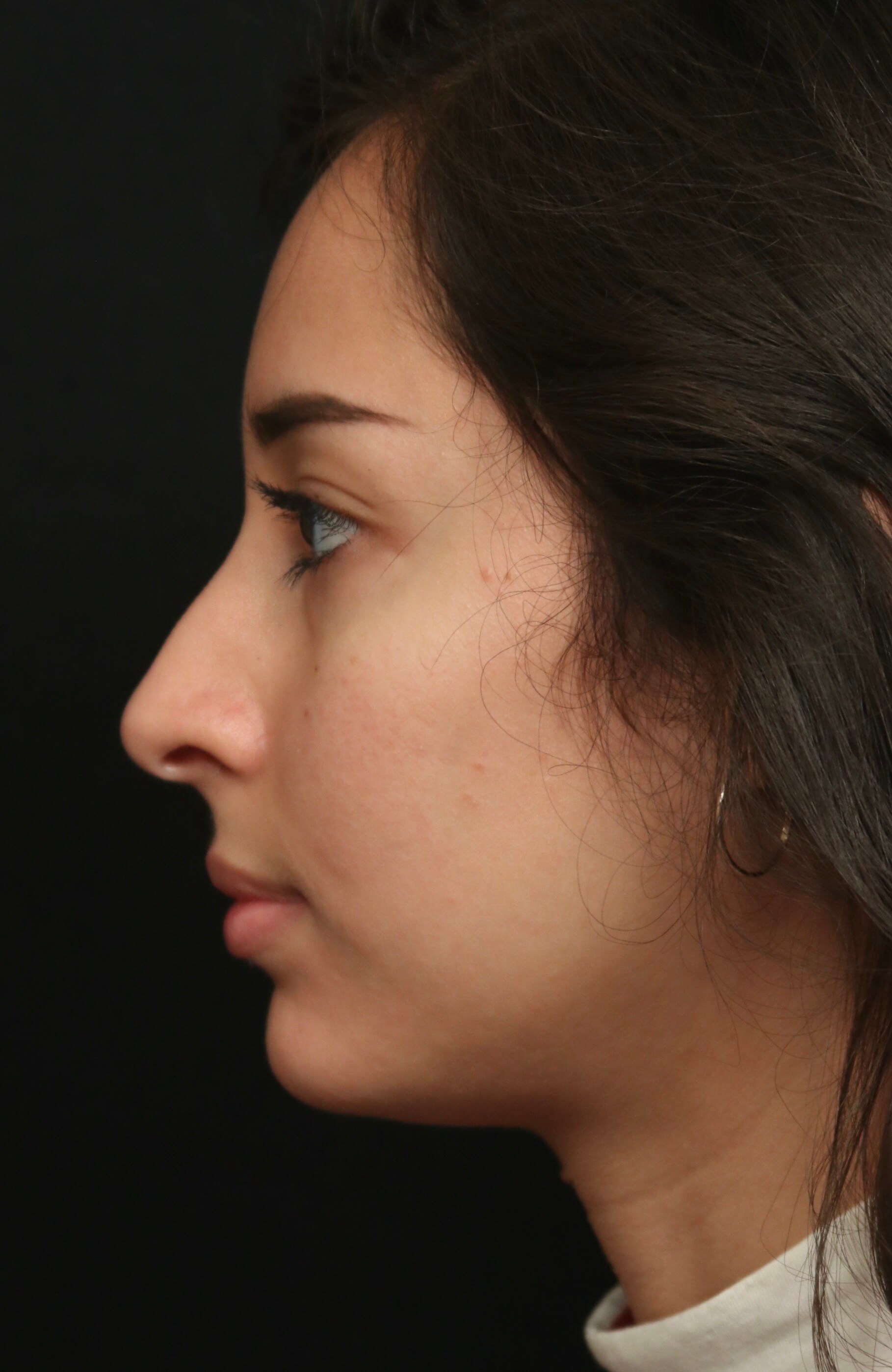 Rhinoplasty Before and After Before