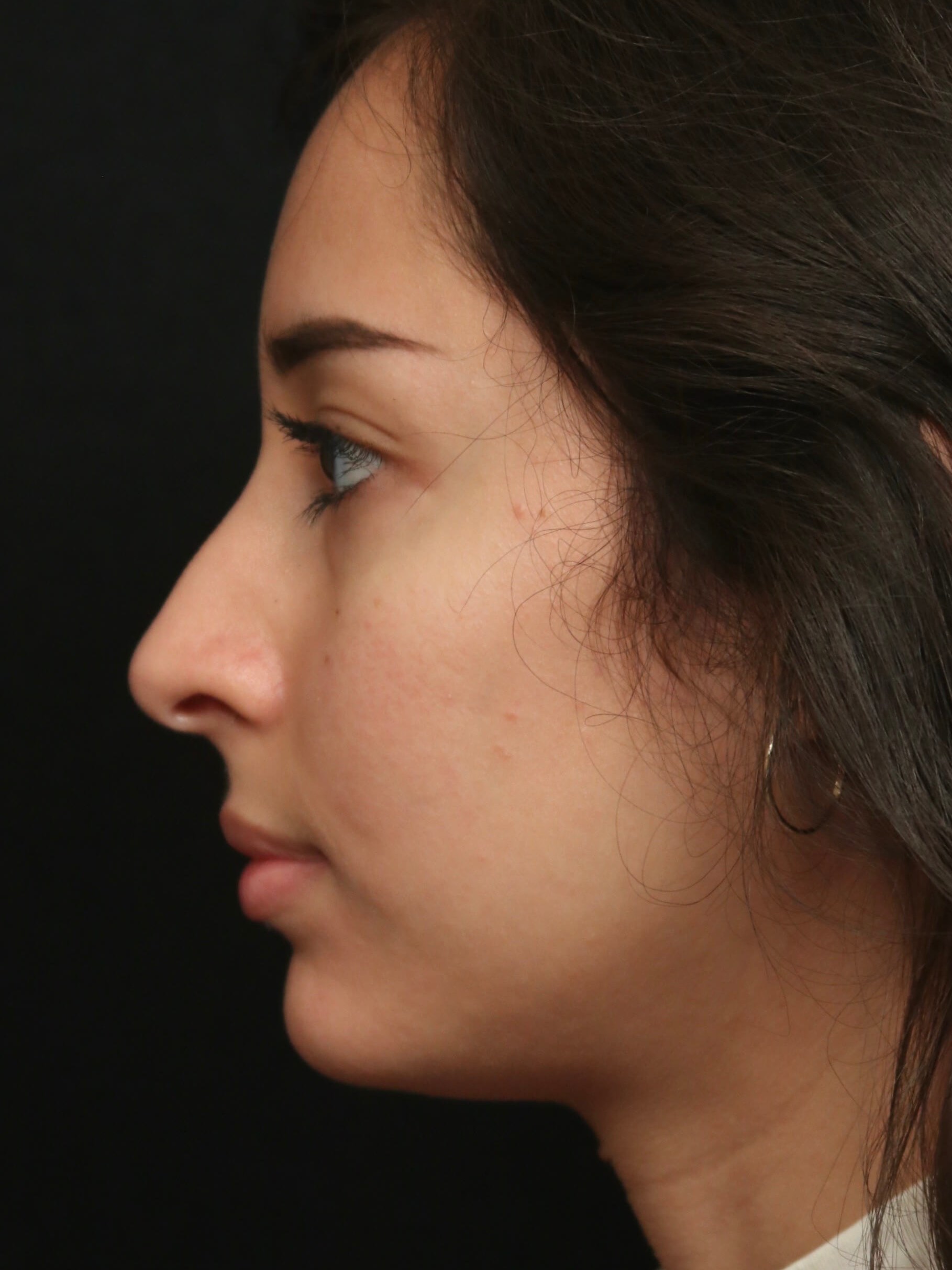 Rhinoplasty Before and After Before