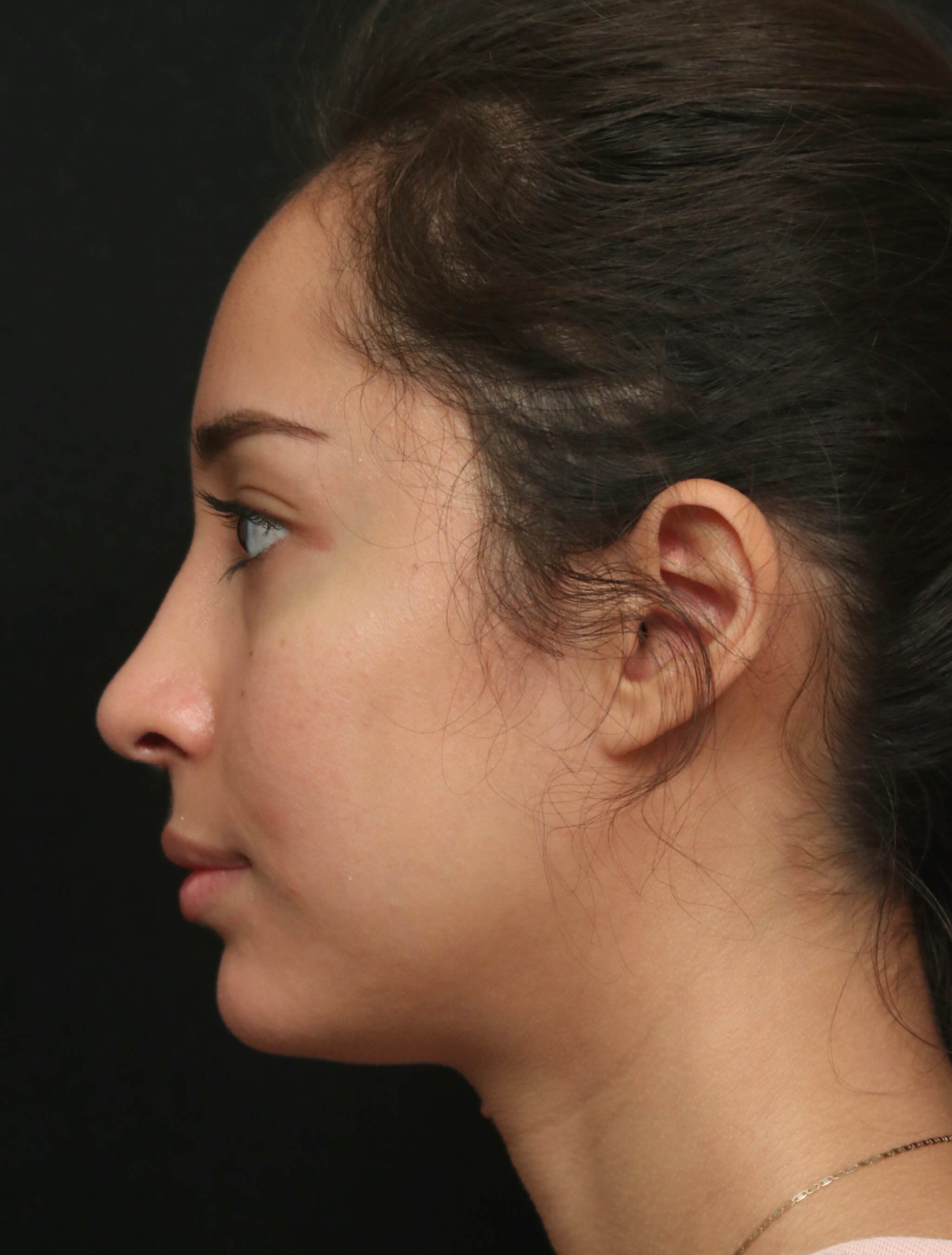 Rhinoplasty Before and After After