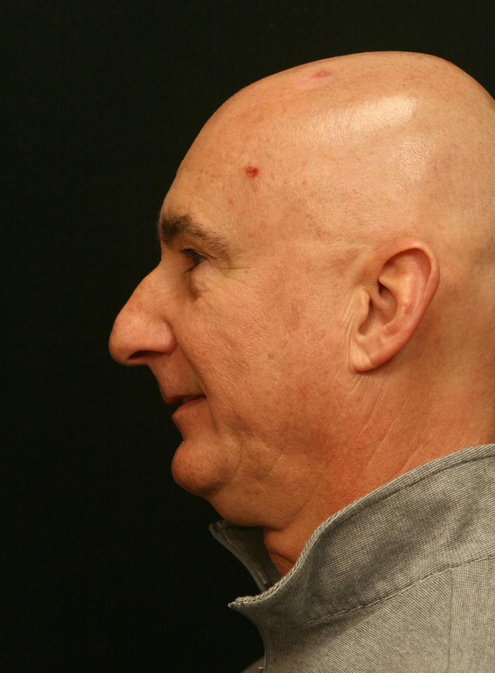 Rhinoplasty Before and After Before