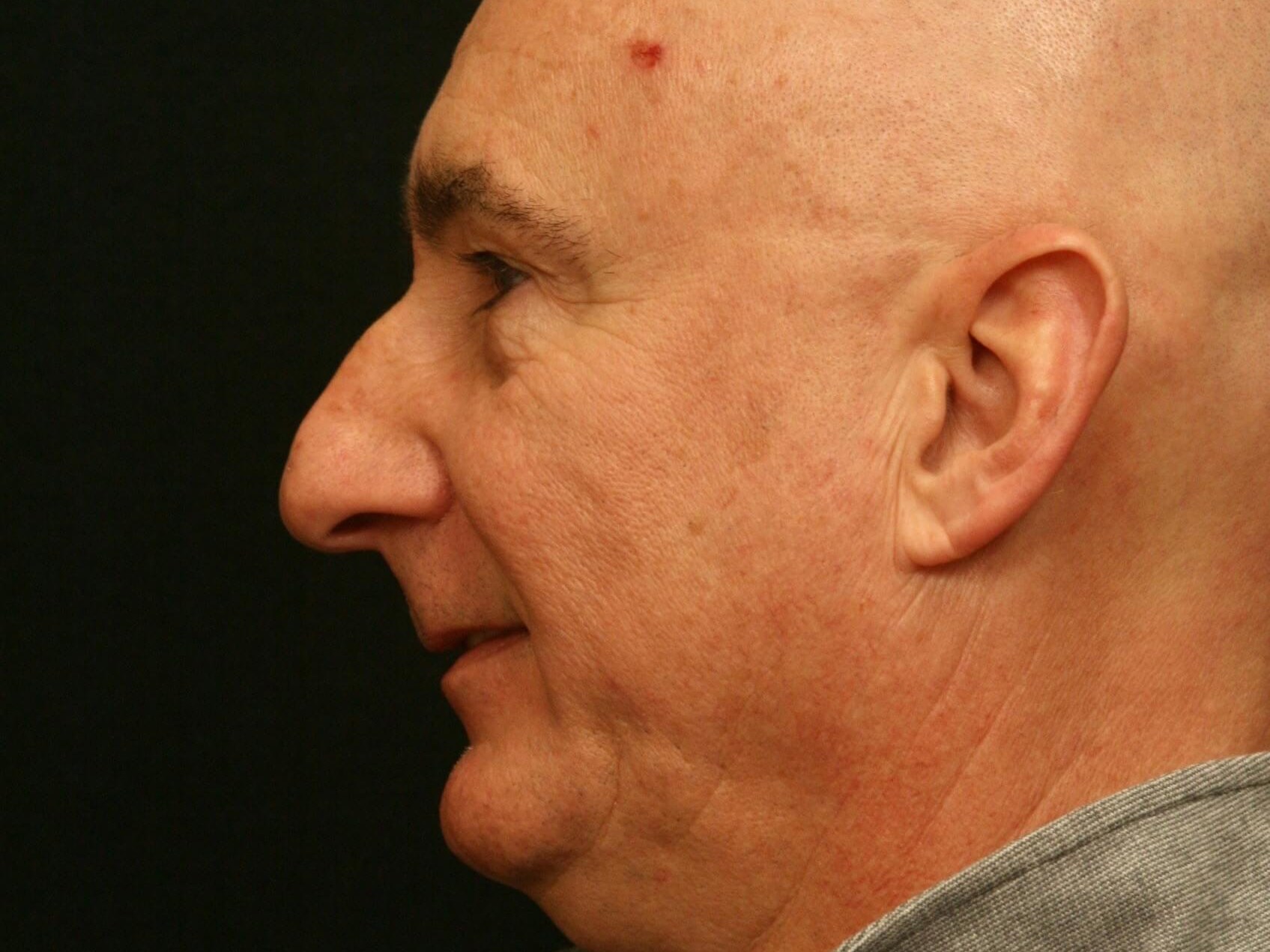 Rhinoplasty Before and After Before