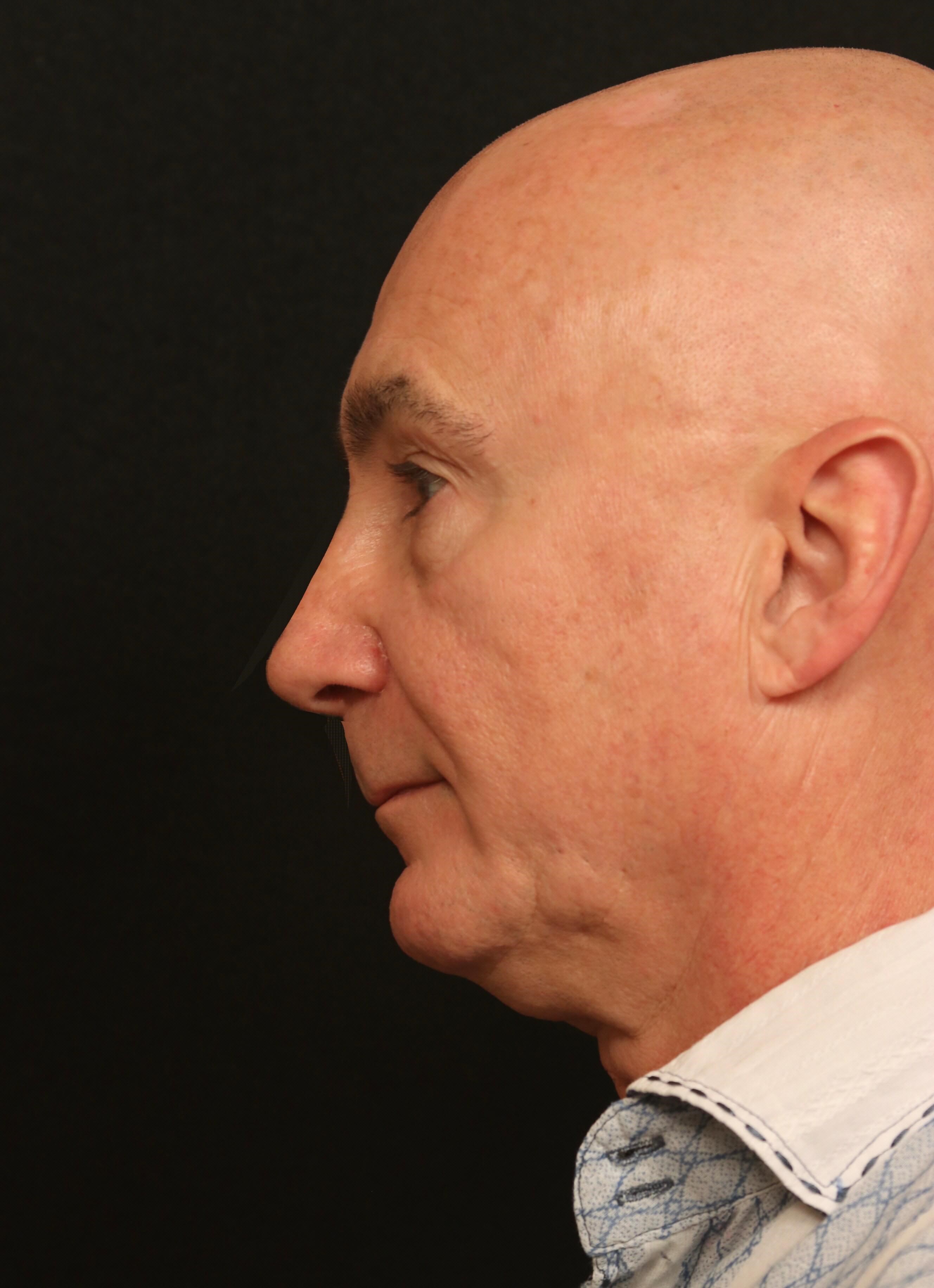 Rhinoplasty Before and After After