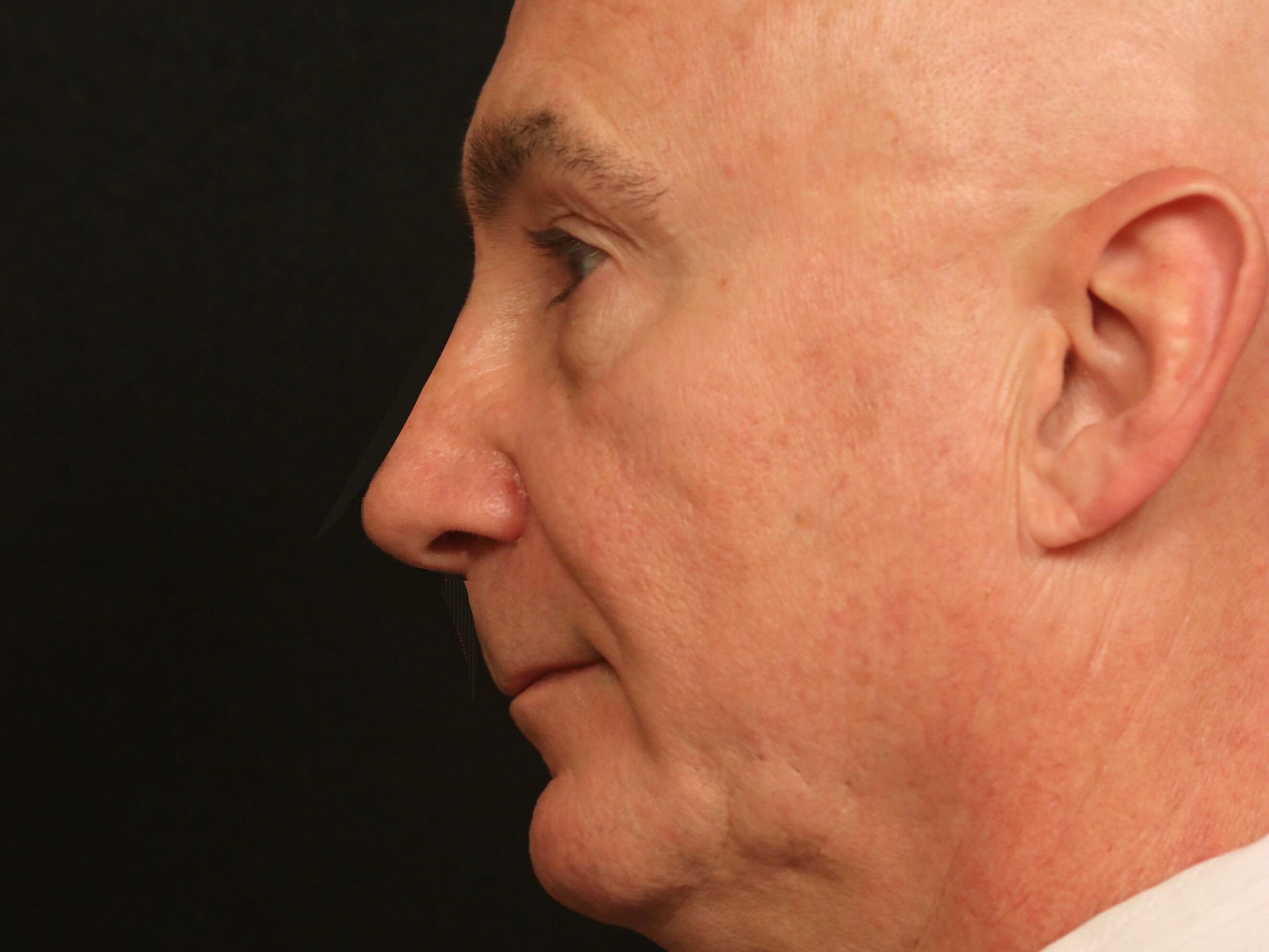 Rhinoplasty Before and After After