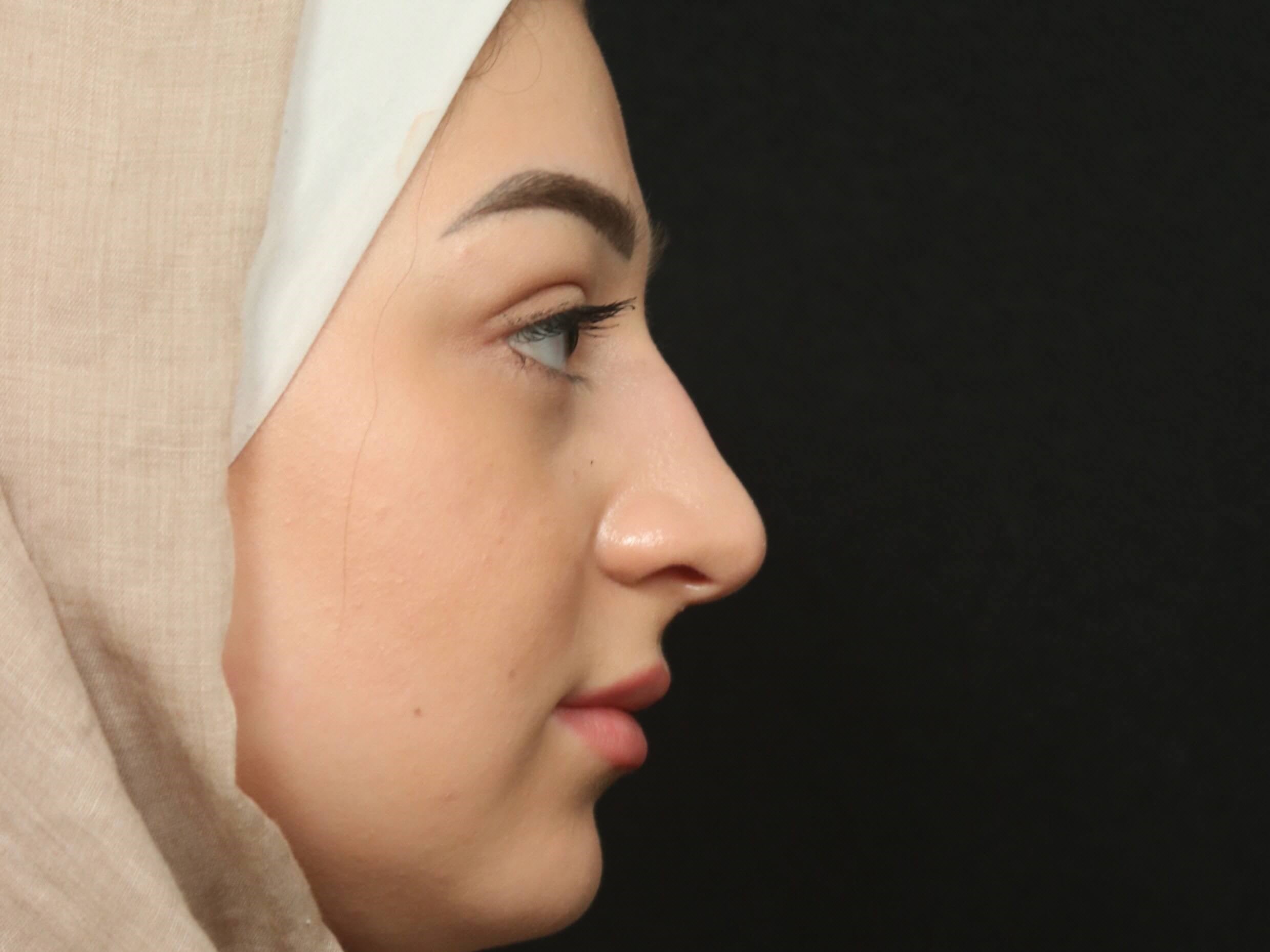 Rhinoplasty Before and After Before