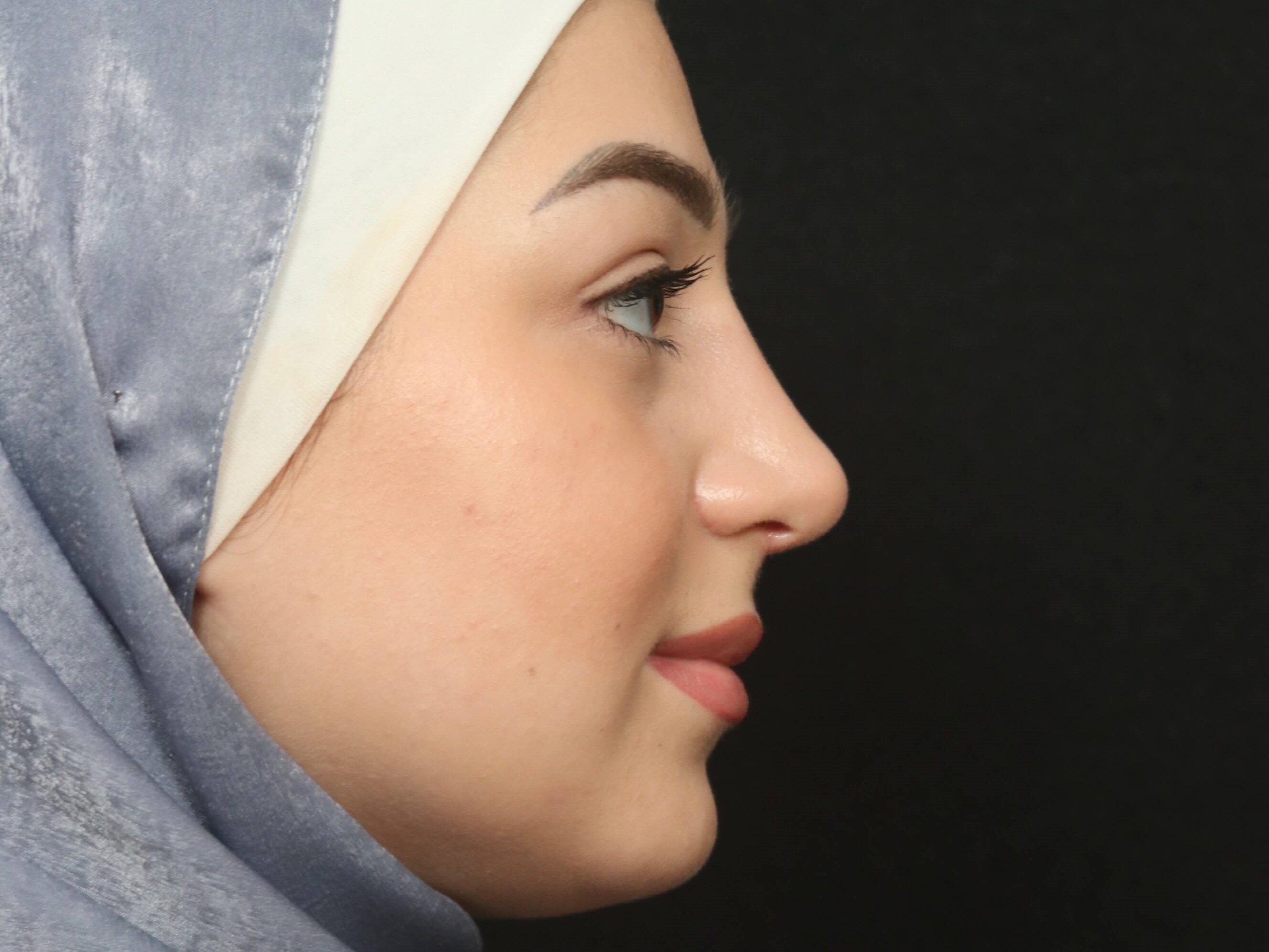 Rhinoplasty Before and After After