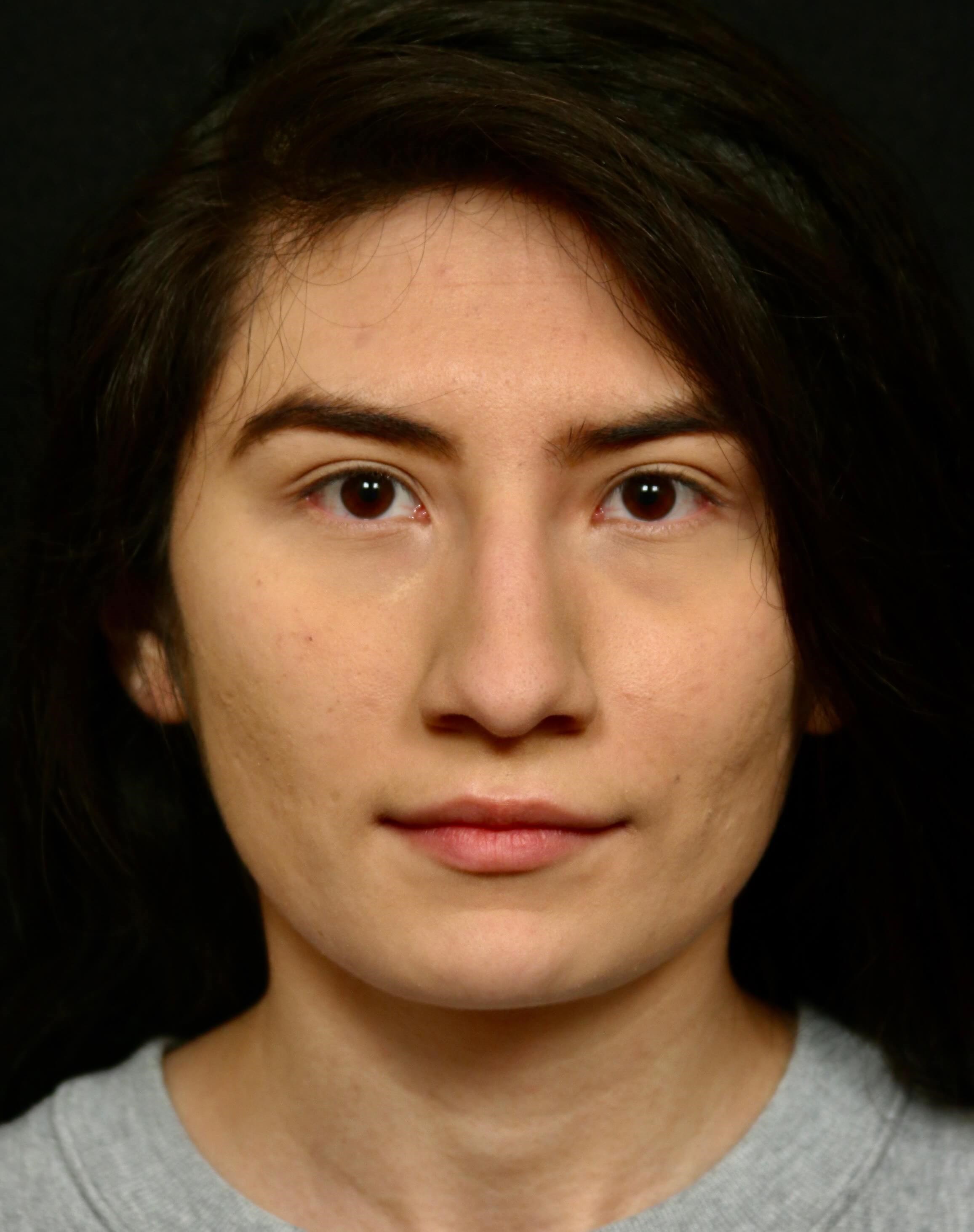 Rhinoplasty Before and After Before