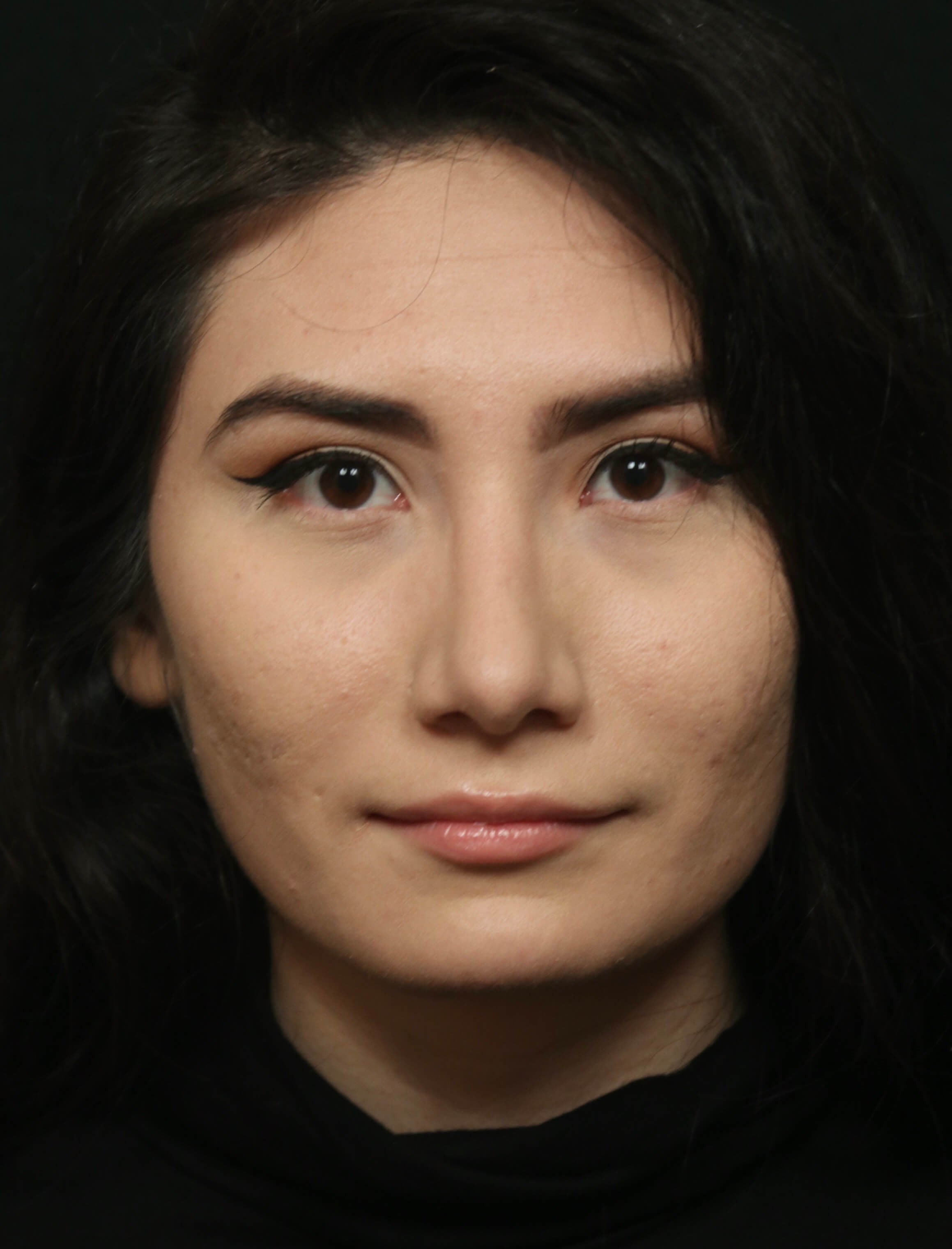 Rhinoplasty Before and After After