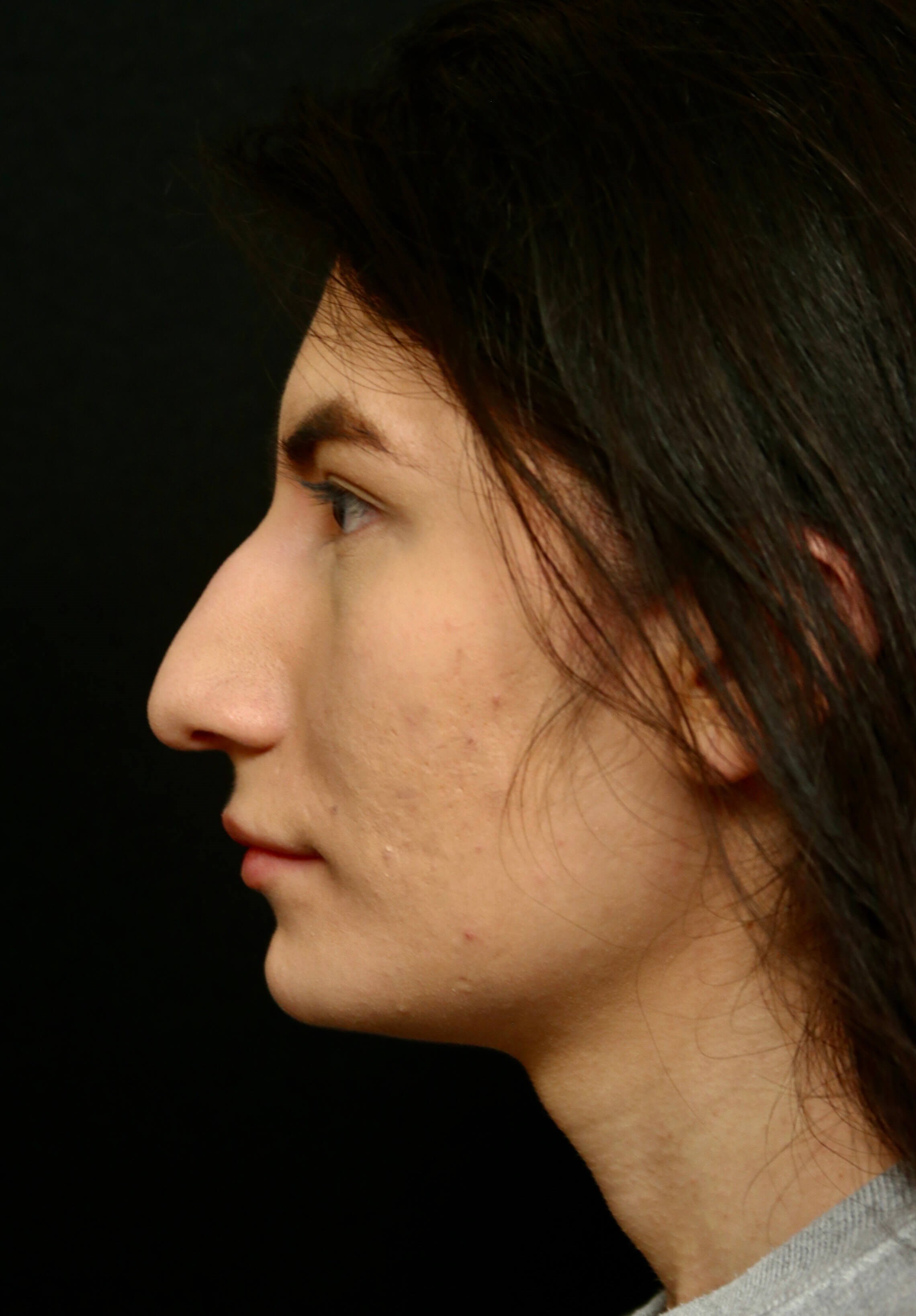 Rhinoplasty Before and After Before