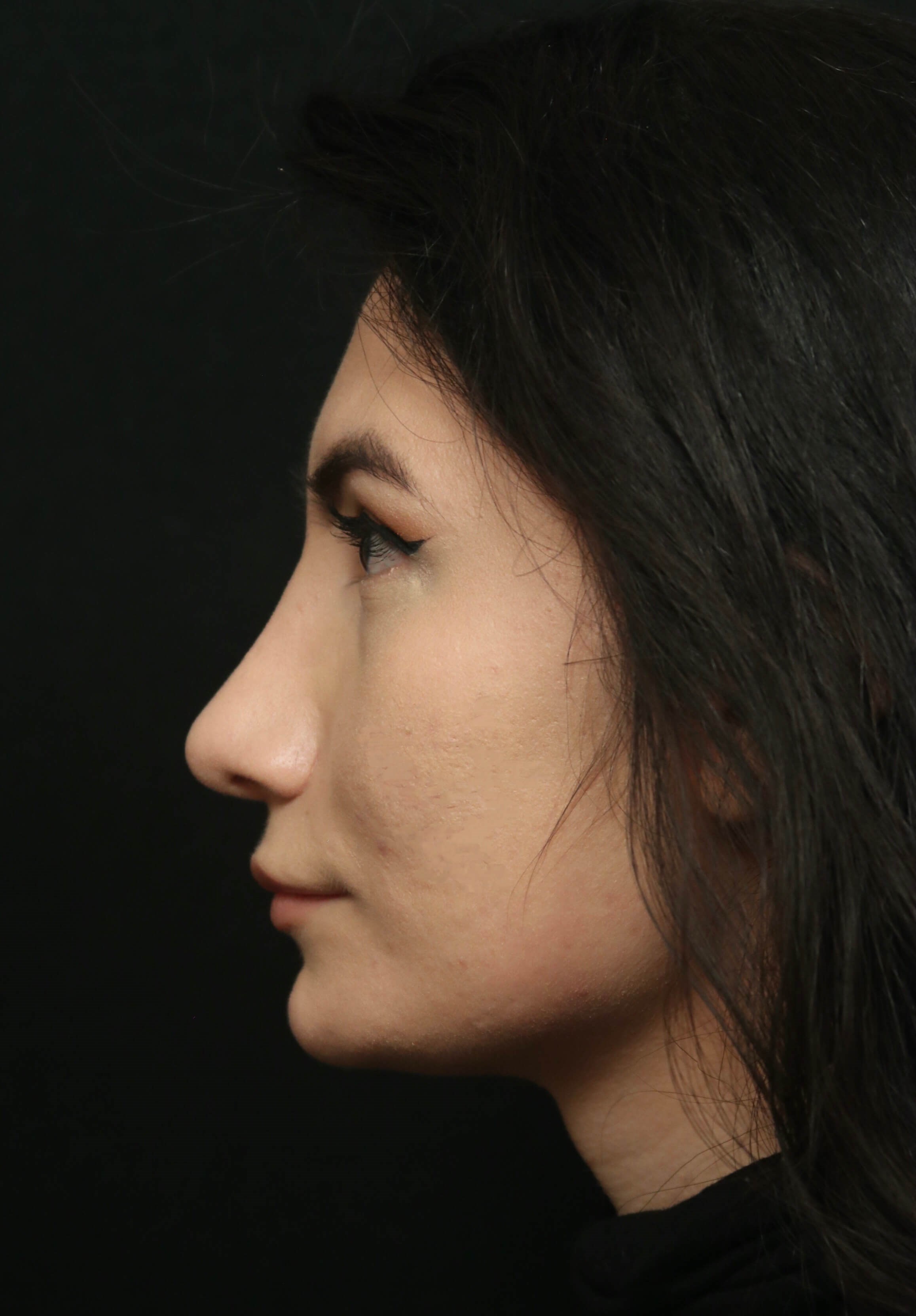 Rhinoplasty Before and After After