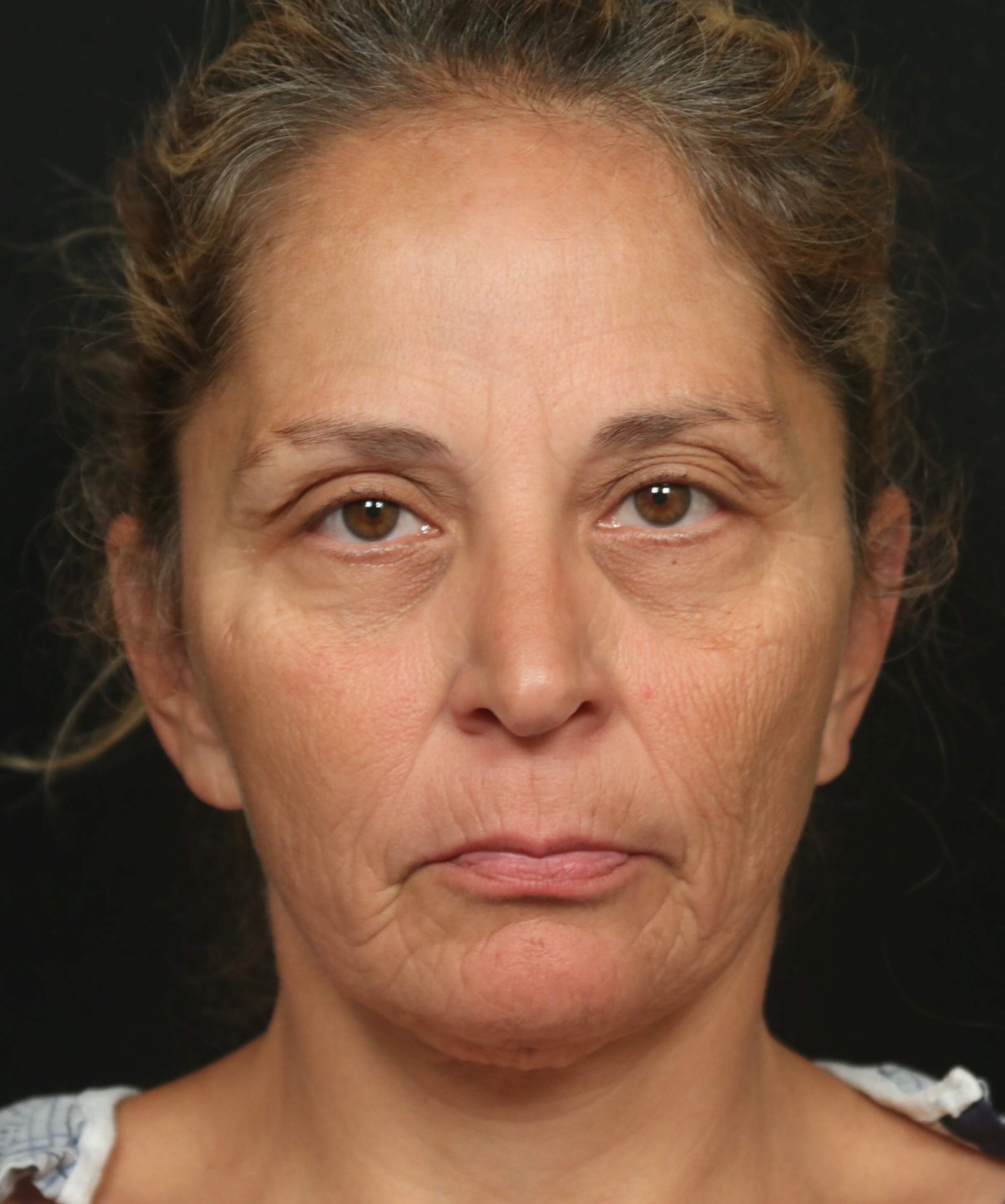 Procedure Before and After Before