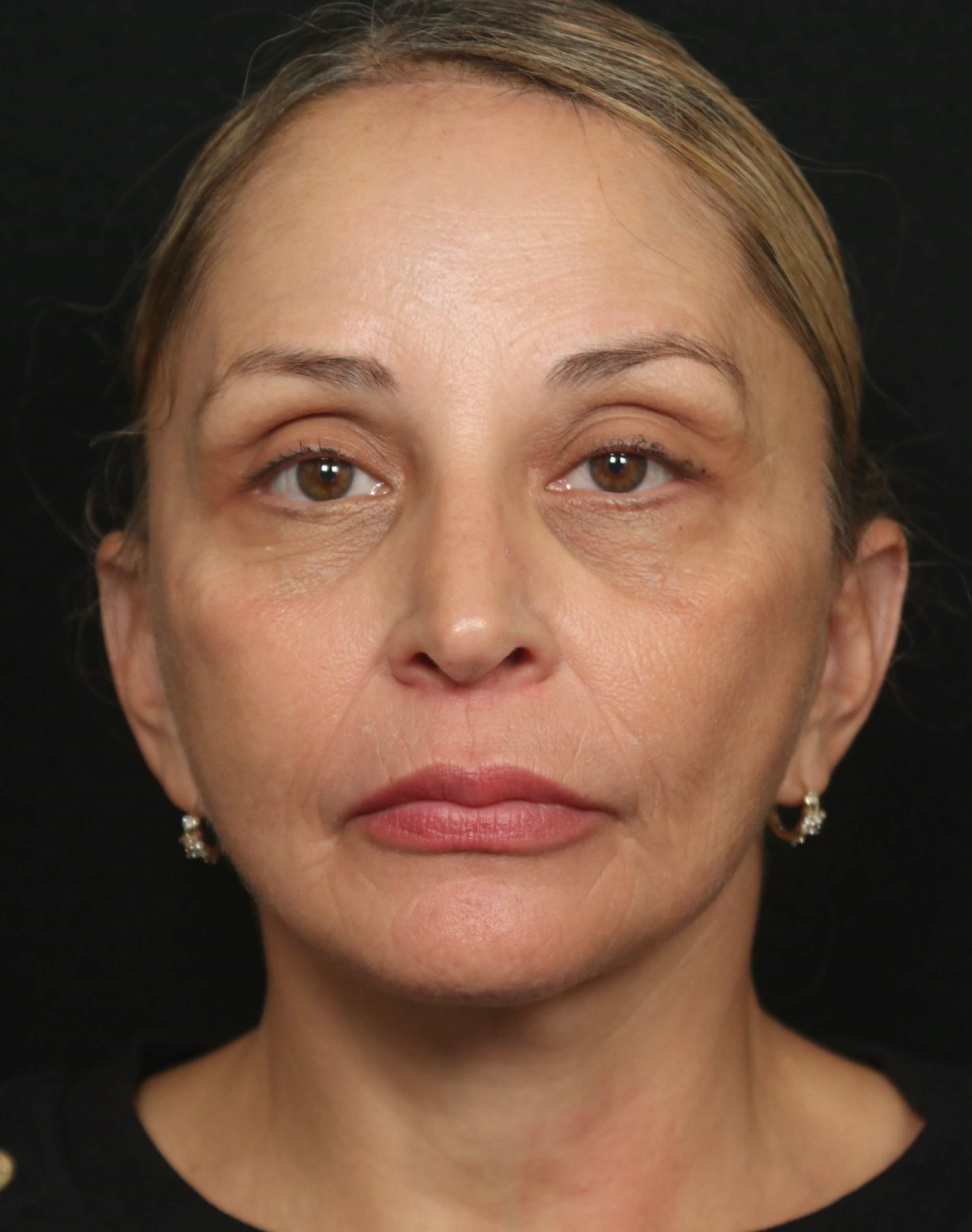 Procedure Before and After After